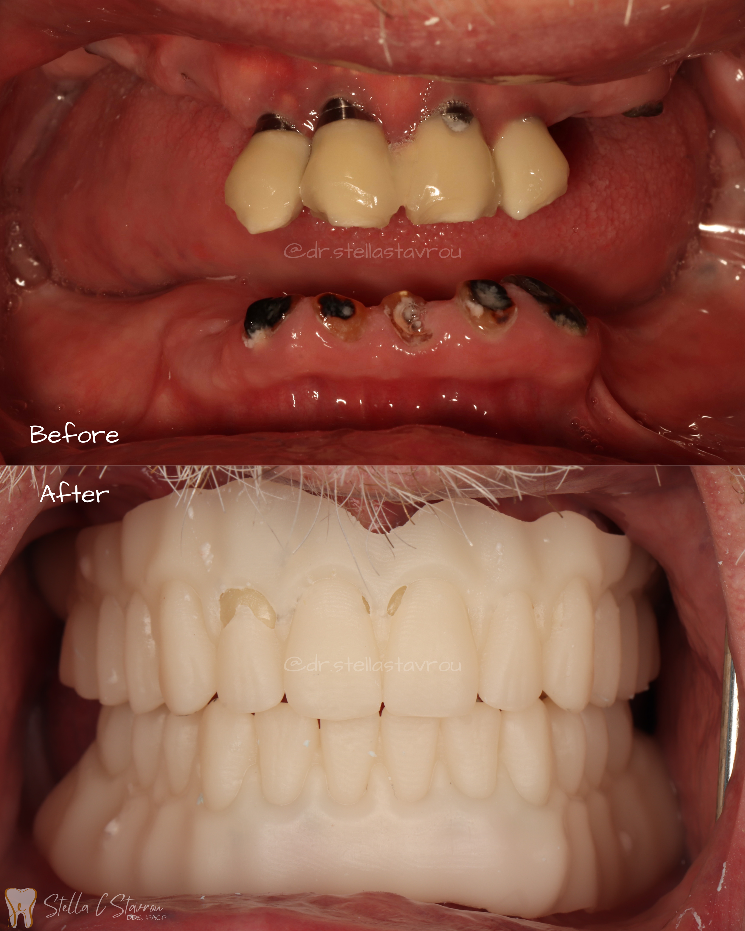 Complete Denture Try-in
