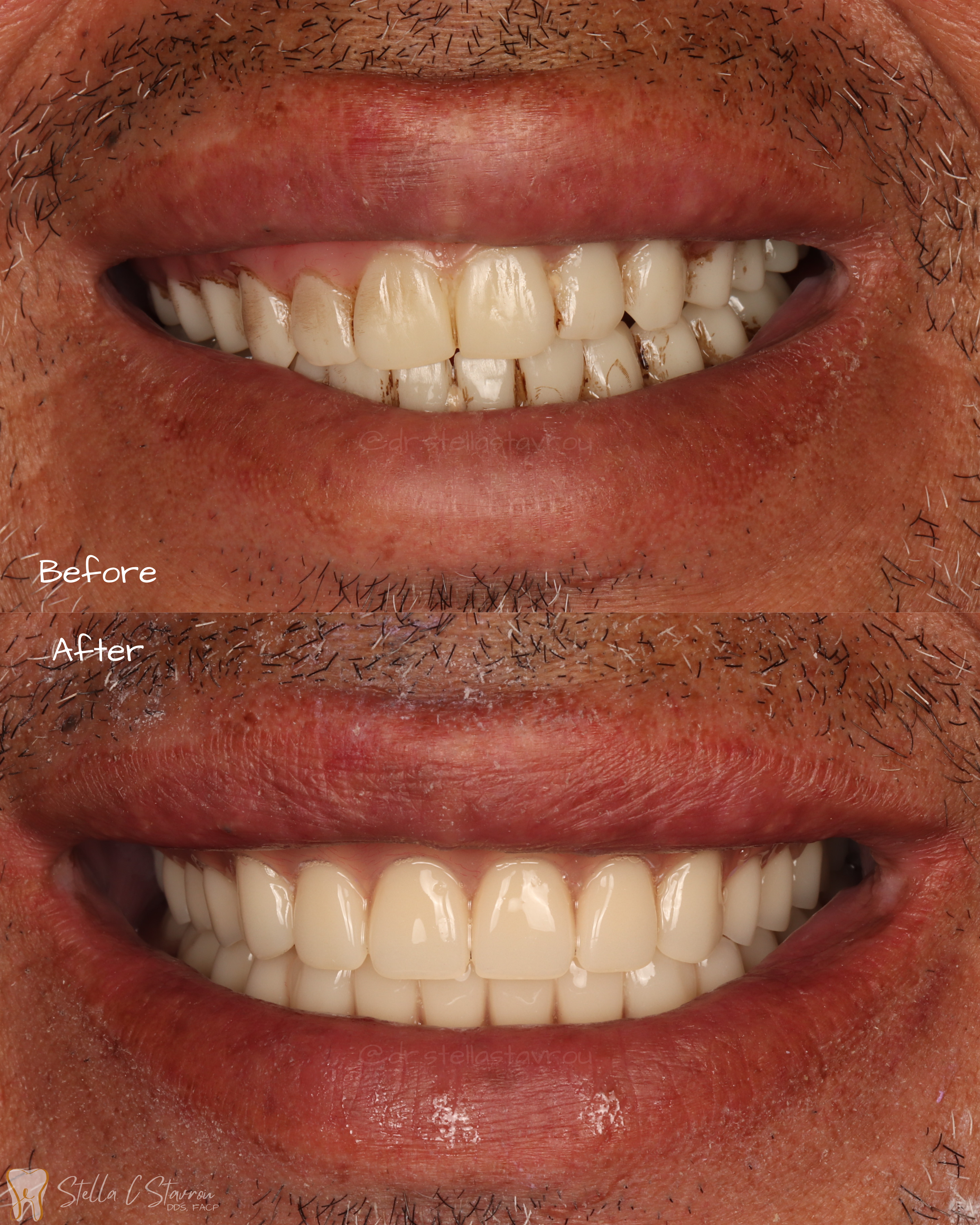 Implant assisted complete overdentures