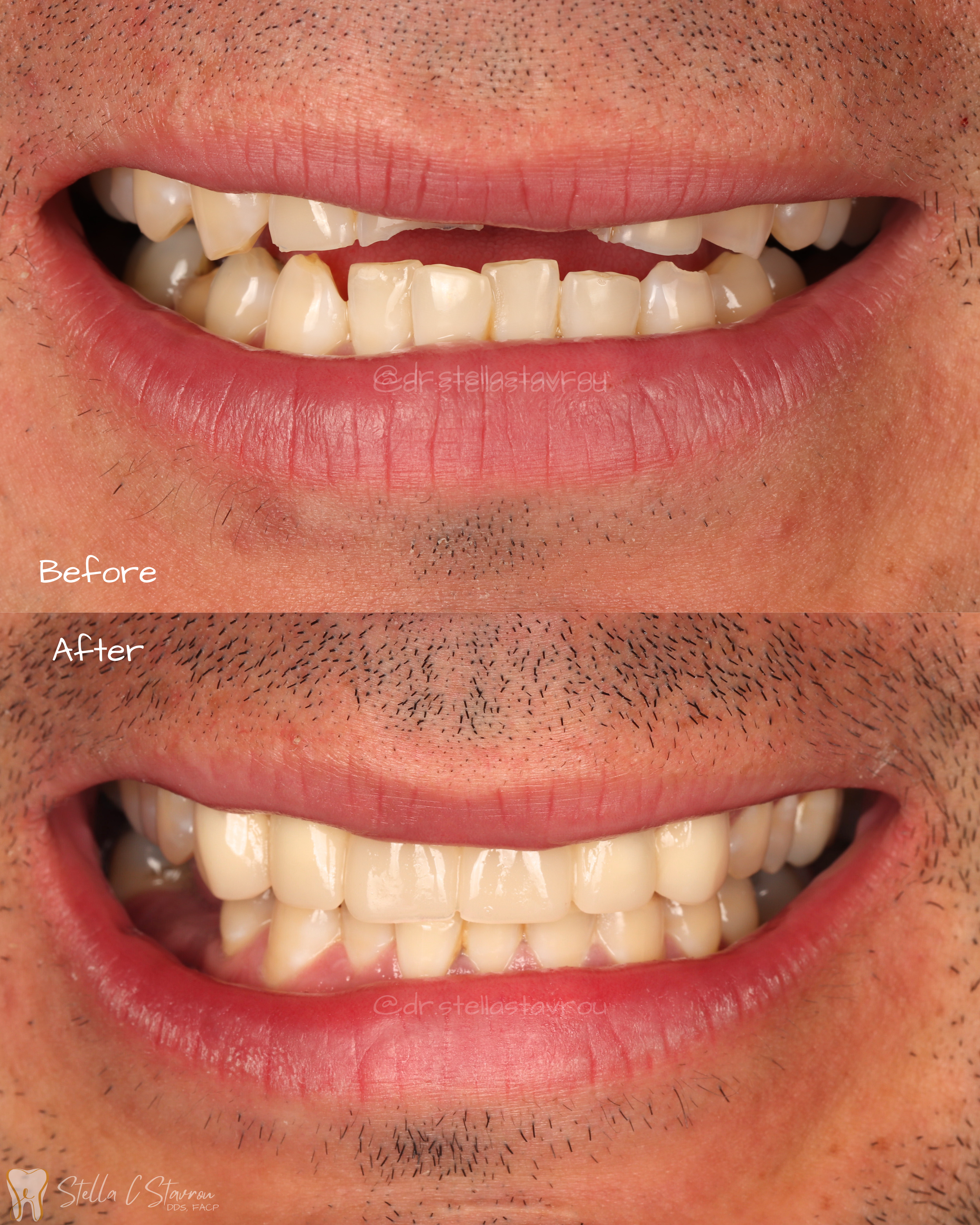 Anterior crowns and bridges