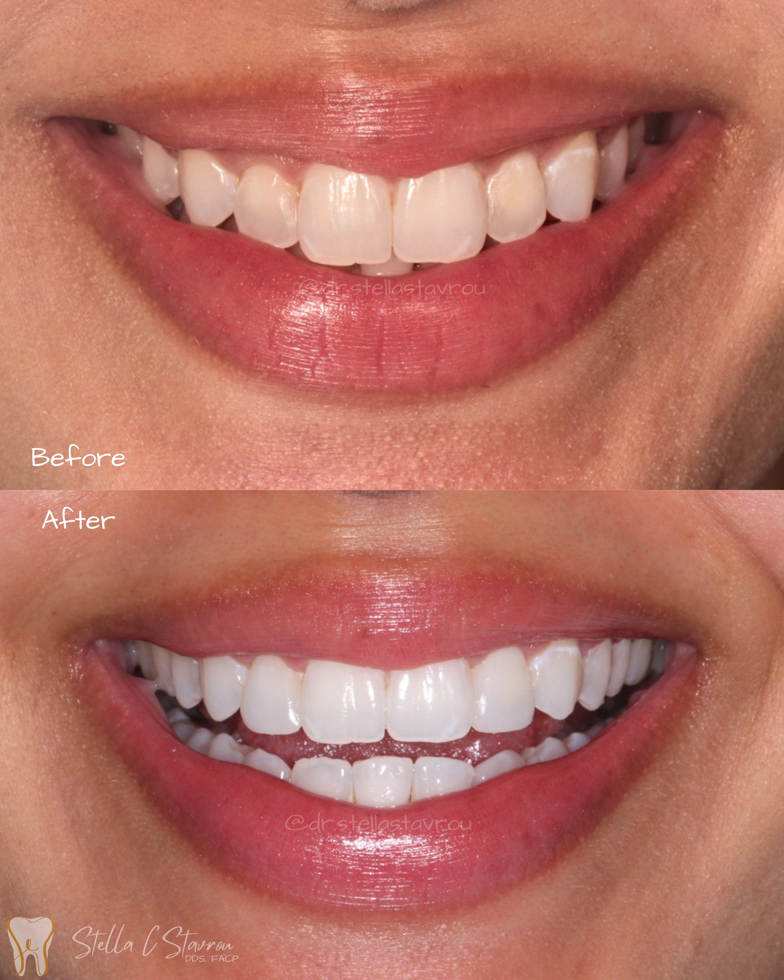 Composite bonding