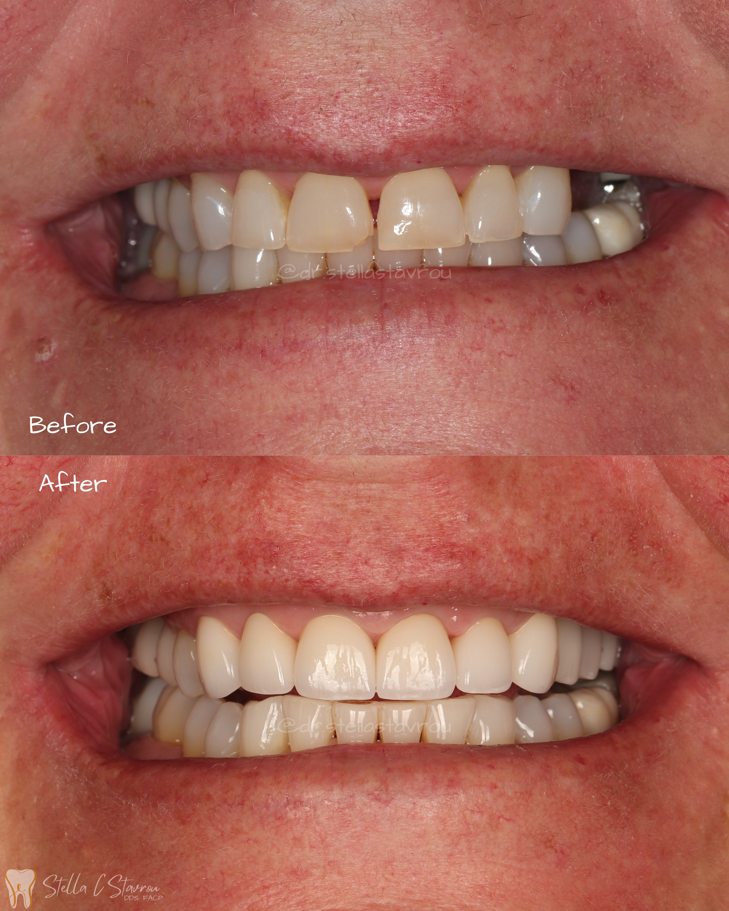Partial rehabilitation with crowns and implant crowns