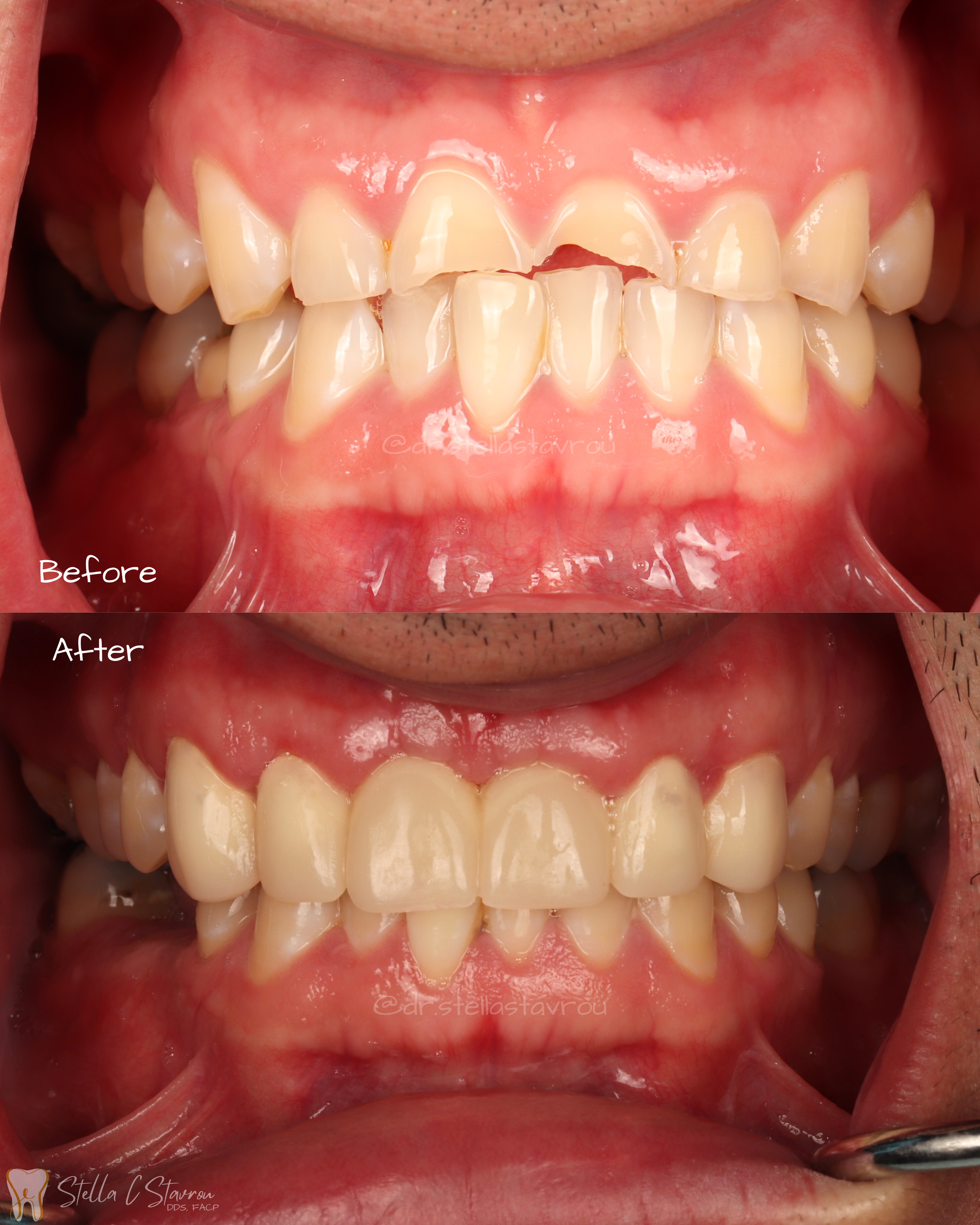 Anterior crowns and bridges