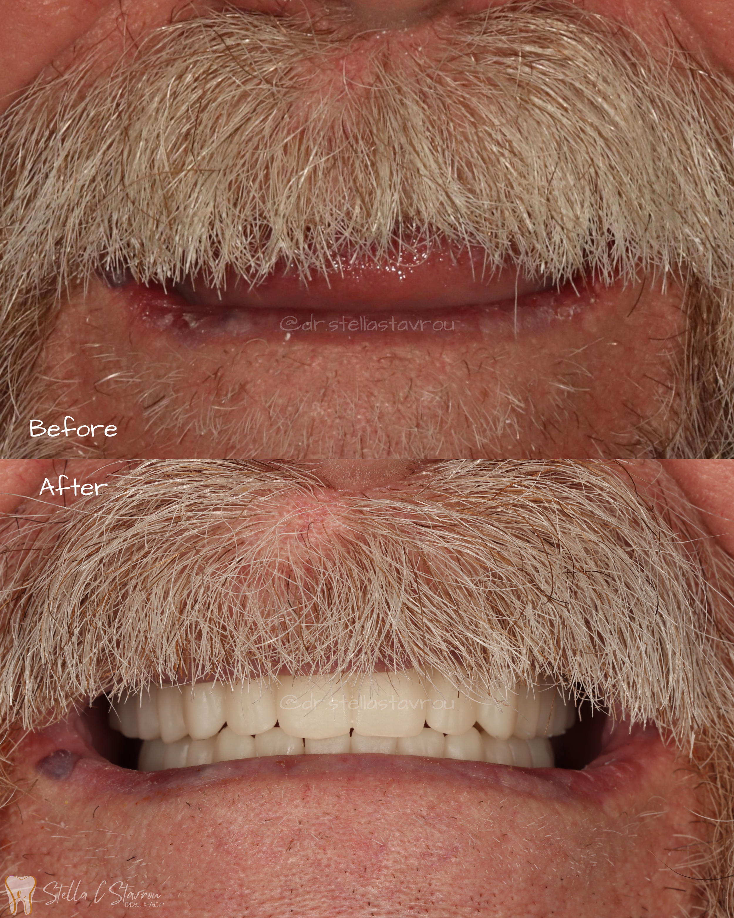 Complete Dentures