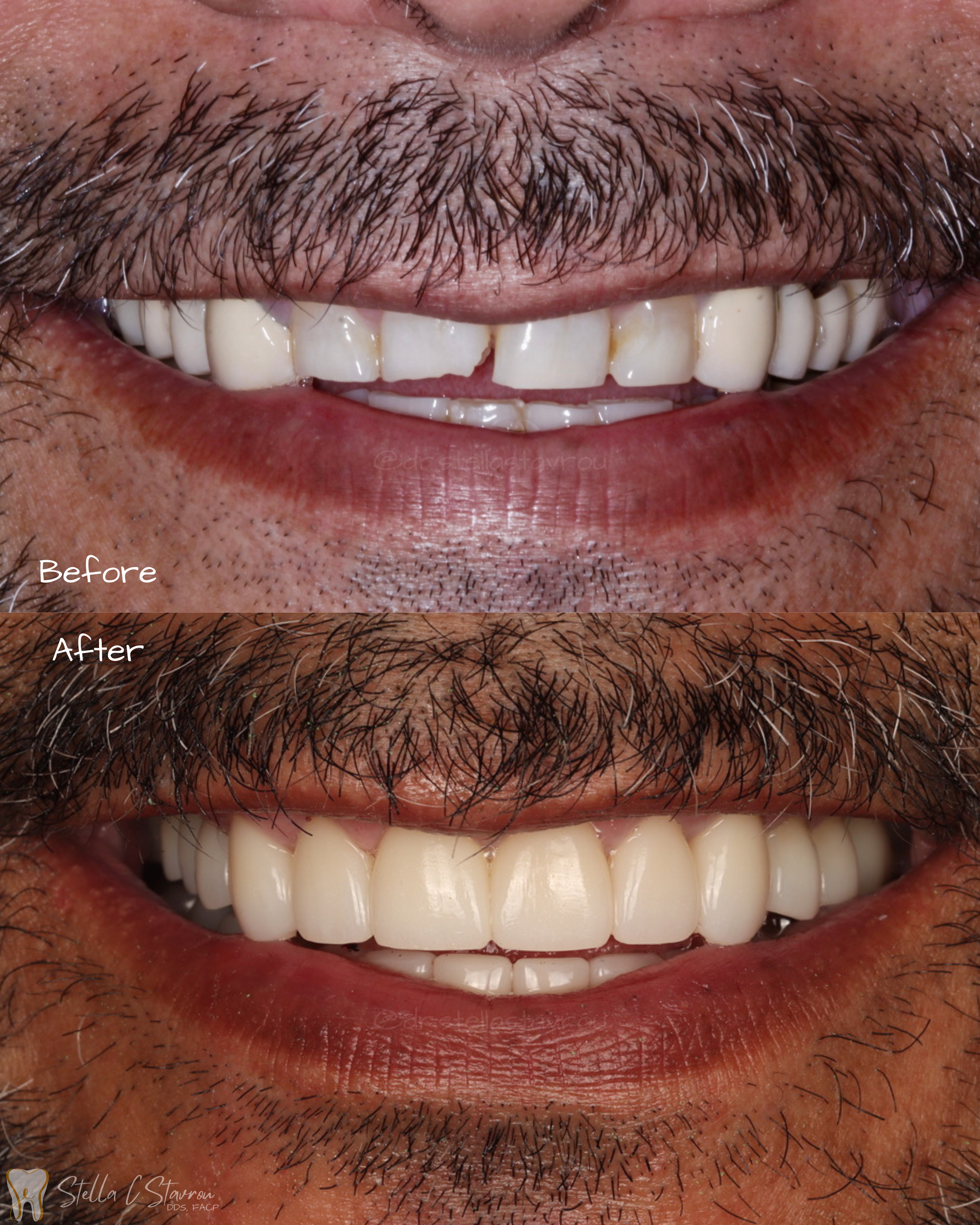 Full mouth rehabilitation with crowns & implant crowns