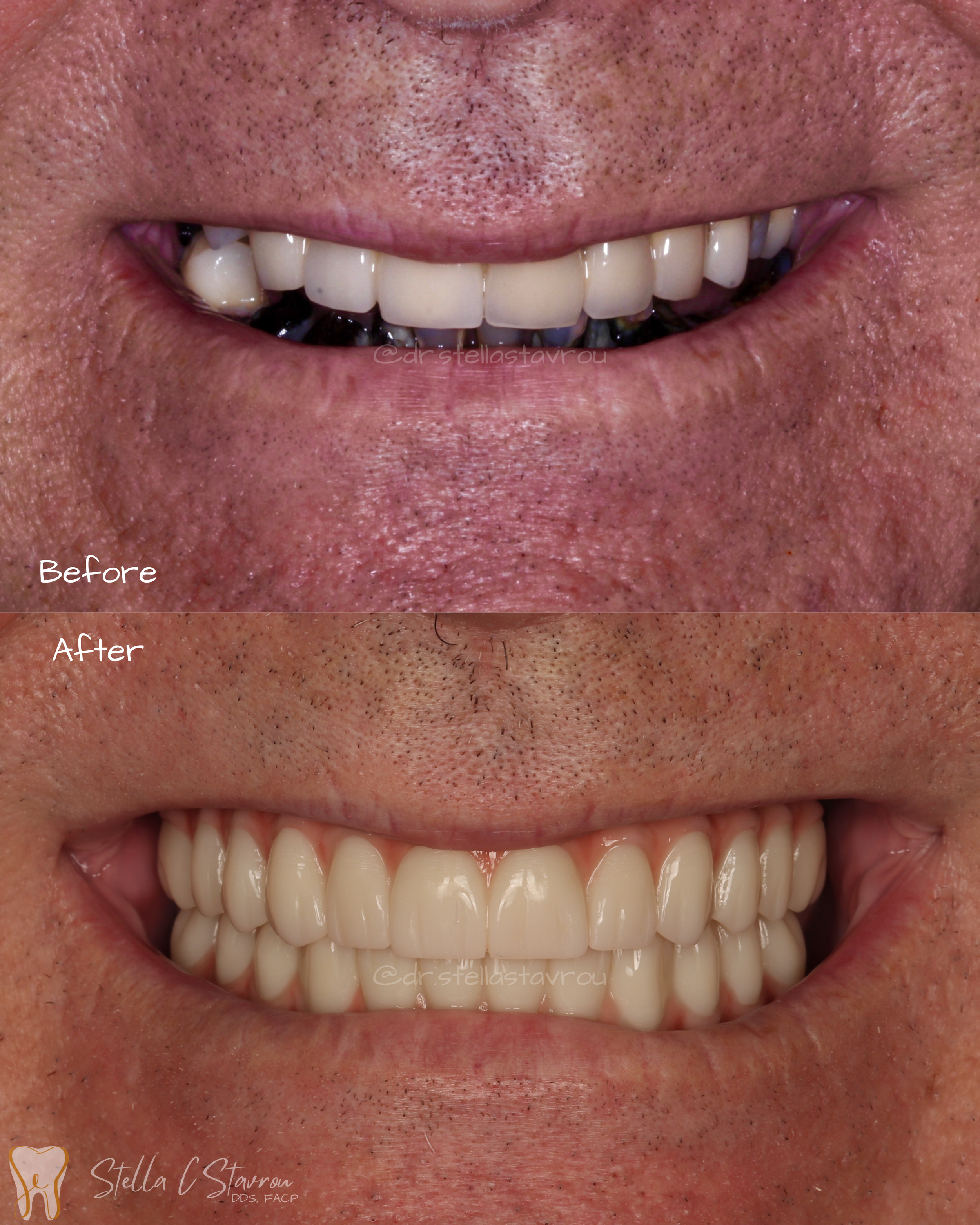 All-on-X implant rehabilitation