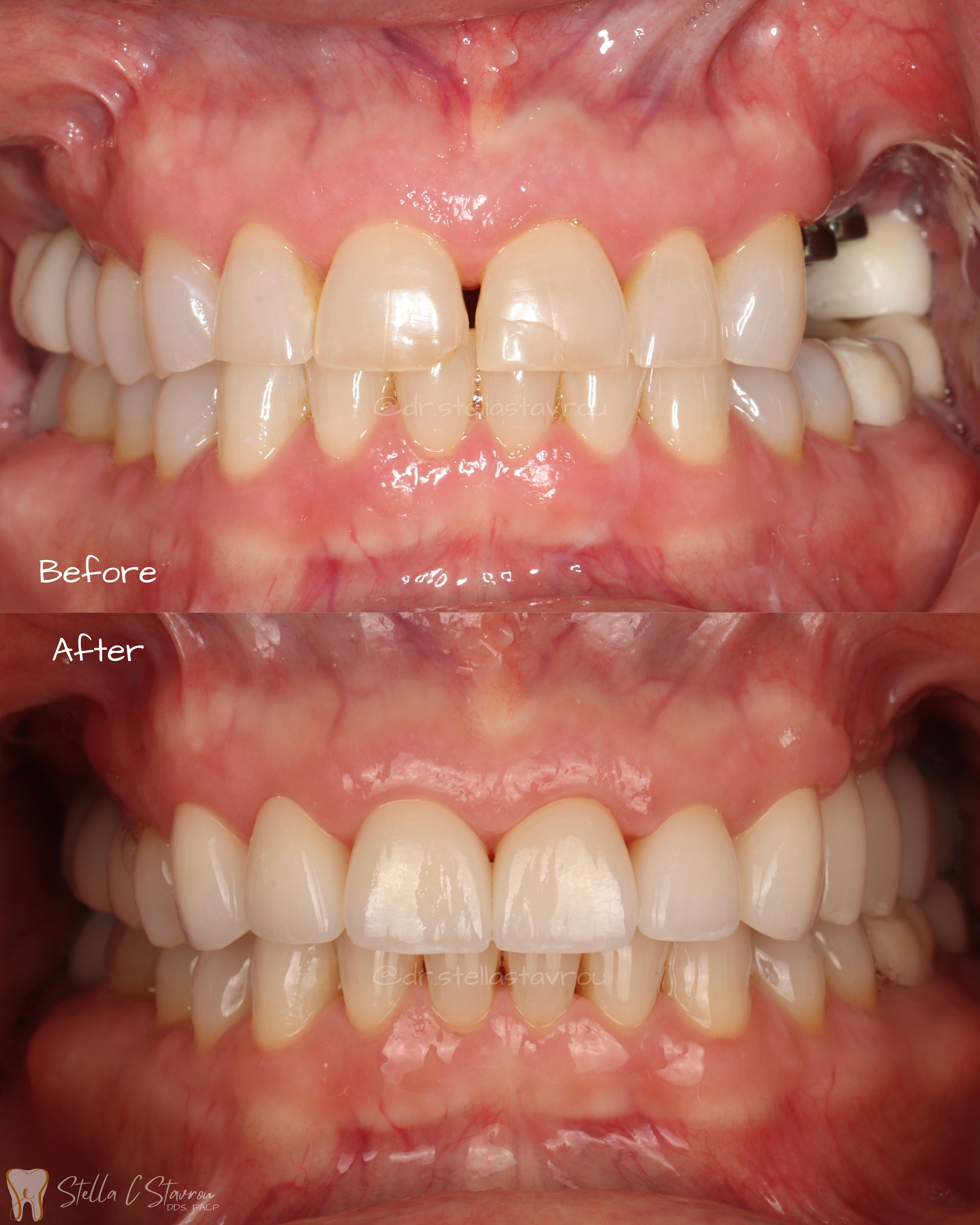 Partial rehabilitation with crowns and implant crowns