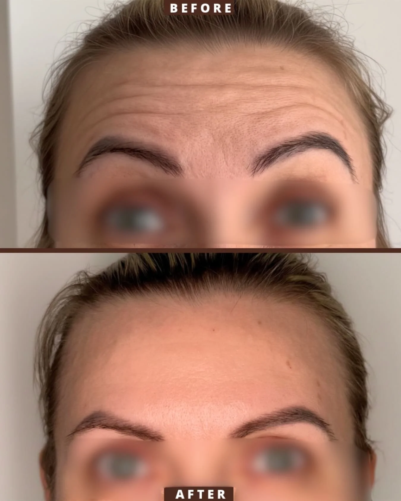 Forehead anti-wrinkle treatment ✨

Smooth, refreshed, and still able to look surprised when needed 🤍

Anti-wrinkle treatment works by relaxing the muscles that create forehead lines from repeated movement over time. The aim is always soft, natural r