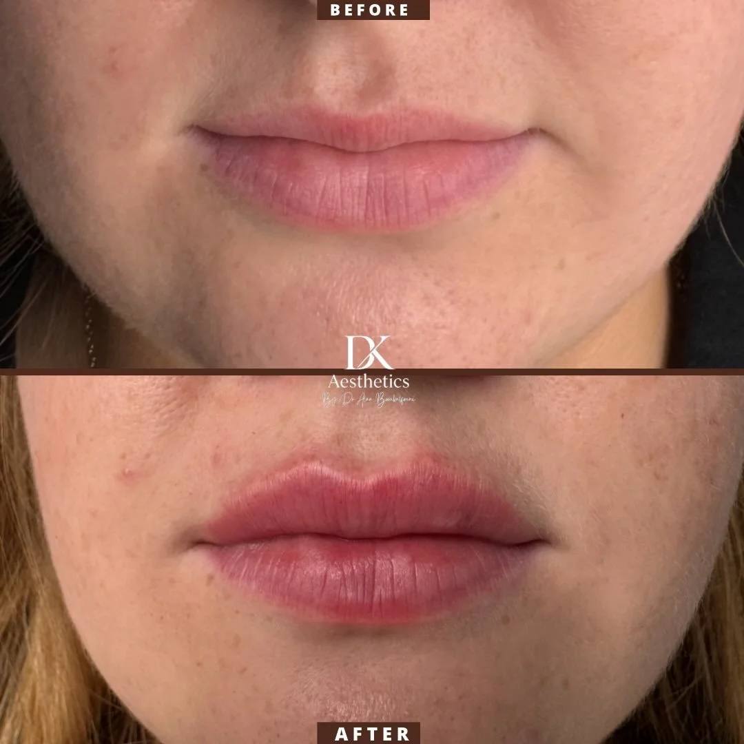 Fresh, hydrated lips with a natural finish ✨
Subtle enhancements make the biggest difference.

Follow for more 🤍
.
.
.
#lips #natural #aesthetic #dublin