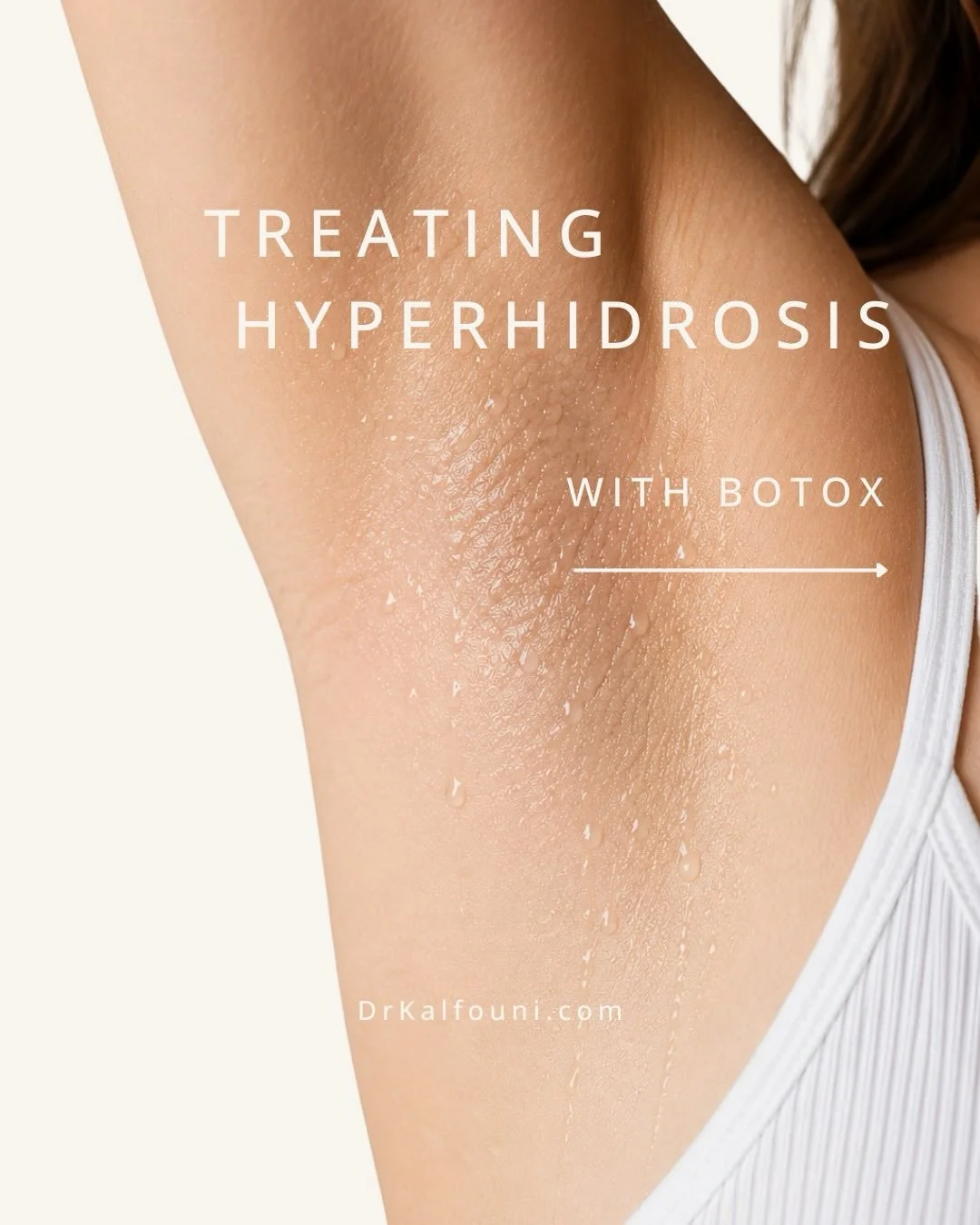 Say goodbye to excessive sweating! 💧

Treating hyperhidrosis with Botox is a safe and effective way to reduce excessive sweat production and restore confidence. By targeting overactive sweat glands, treatment can help keep areas such as the underarm