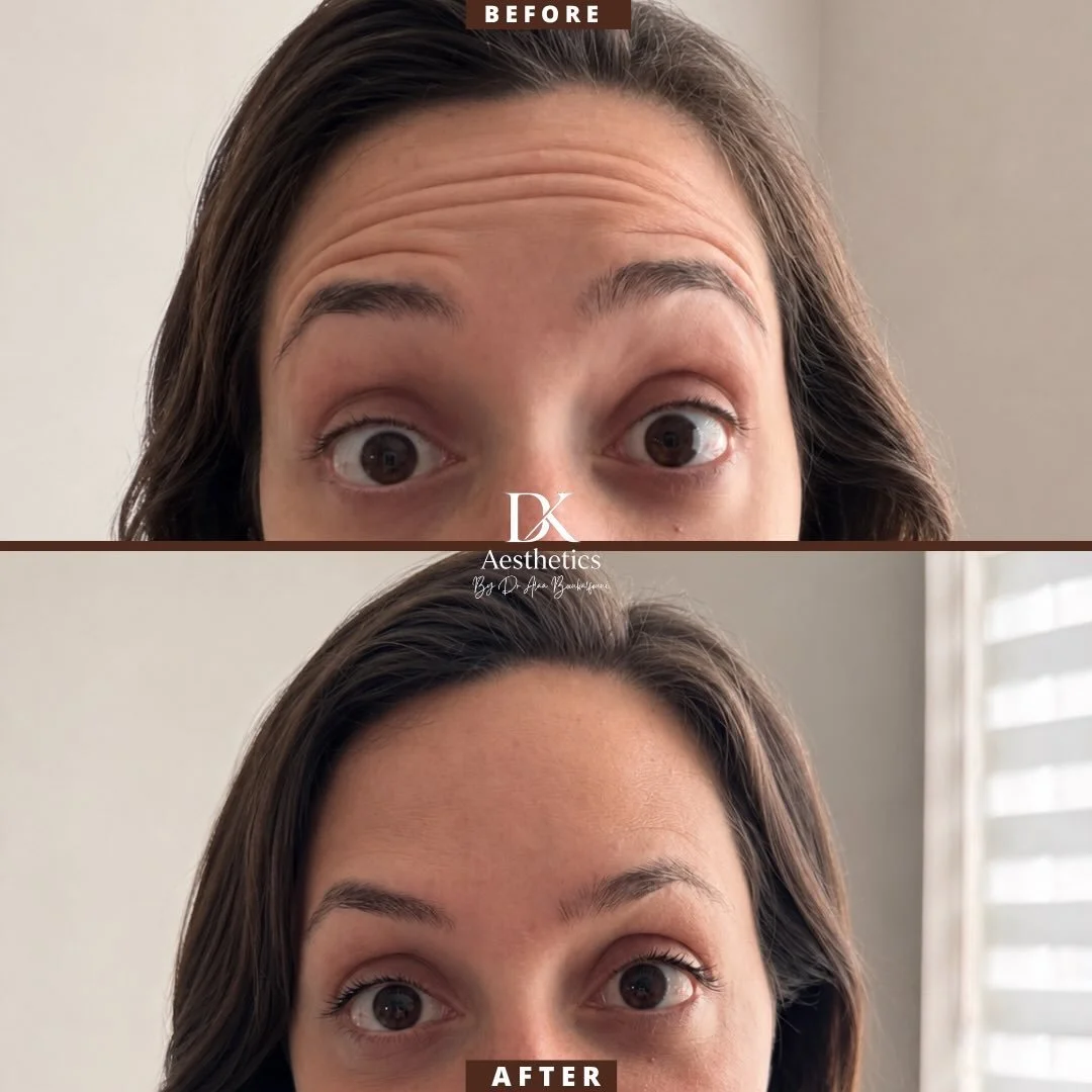 Subtle changes, beautiful results ✨

This client wanted a fresher, more rested appearance without looking &ldquo;done.&rdquo;

By treating the forehead, frown area, and brow area, we achieved smoother skin, softened lines, and a subtle brow lift whil