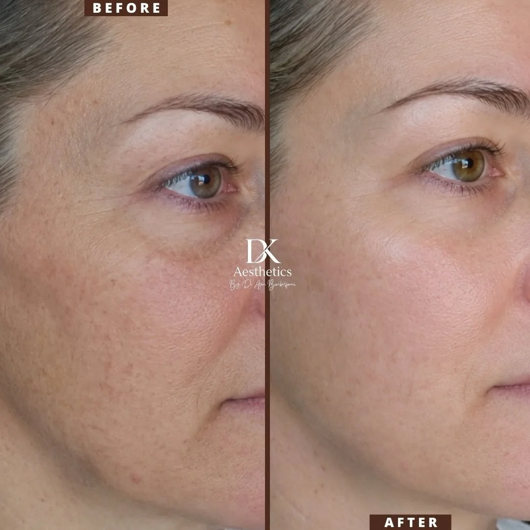 ✨ 3 treatments. 3 weeks apart. Incredible results.

A reminder that true skin regeneration takes time, patience, and consistency.

Thank you to my wonderful client for trusting the process and allowing me to be part of this amazing transformation wit