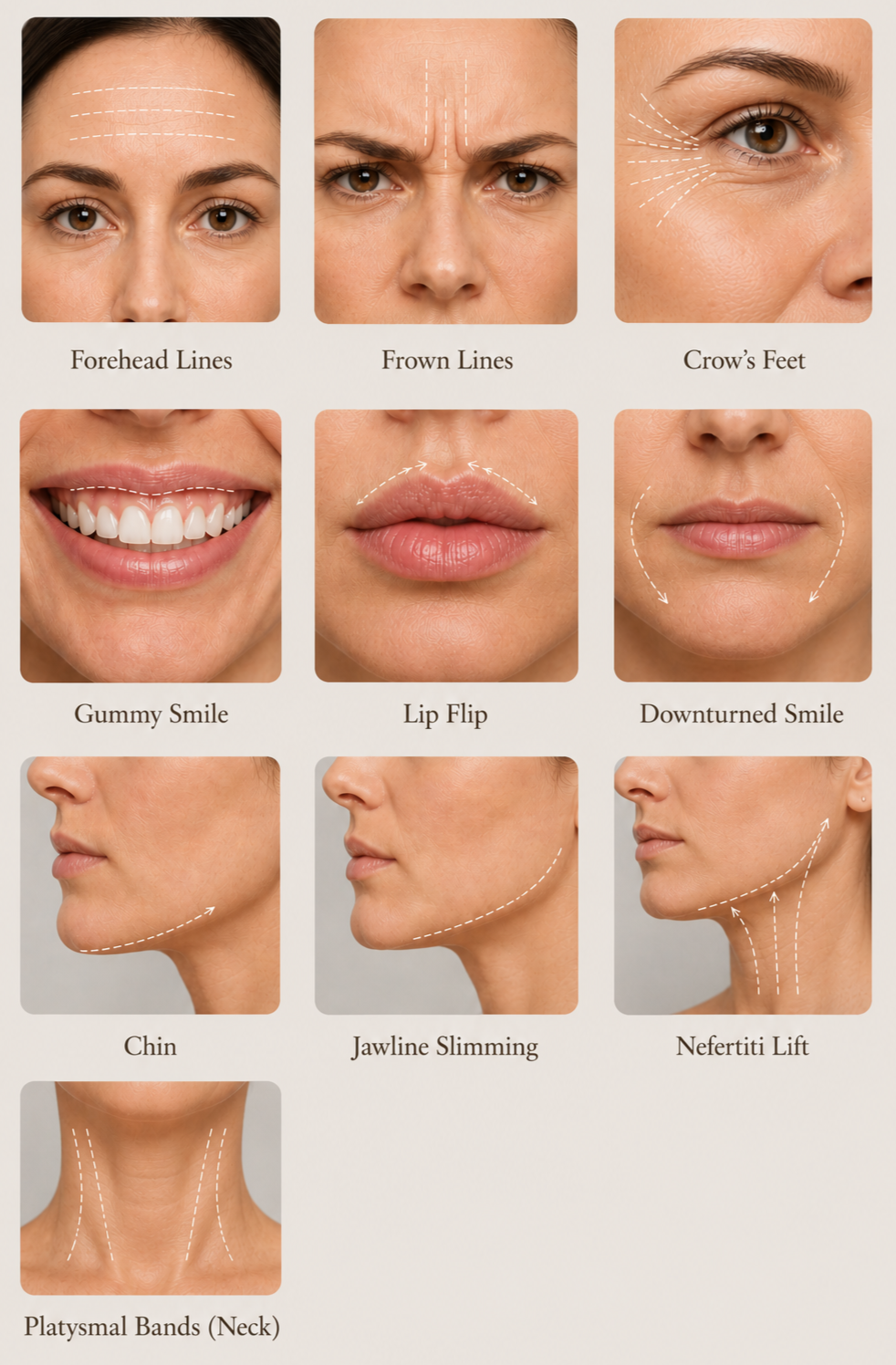 Diagram showing different facial areas with dotted lines indicating cosmetic treatment areas. Areas include forehead lines, frown lines, crow's feet, gummy smile, lip flip, downturned smile, chin, jawline slimming, Nefertiti lift, and platysmal bands (neck).