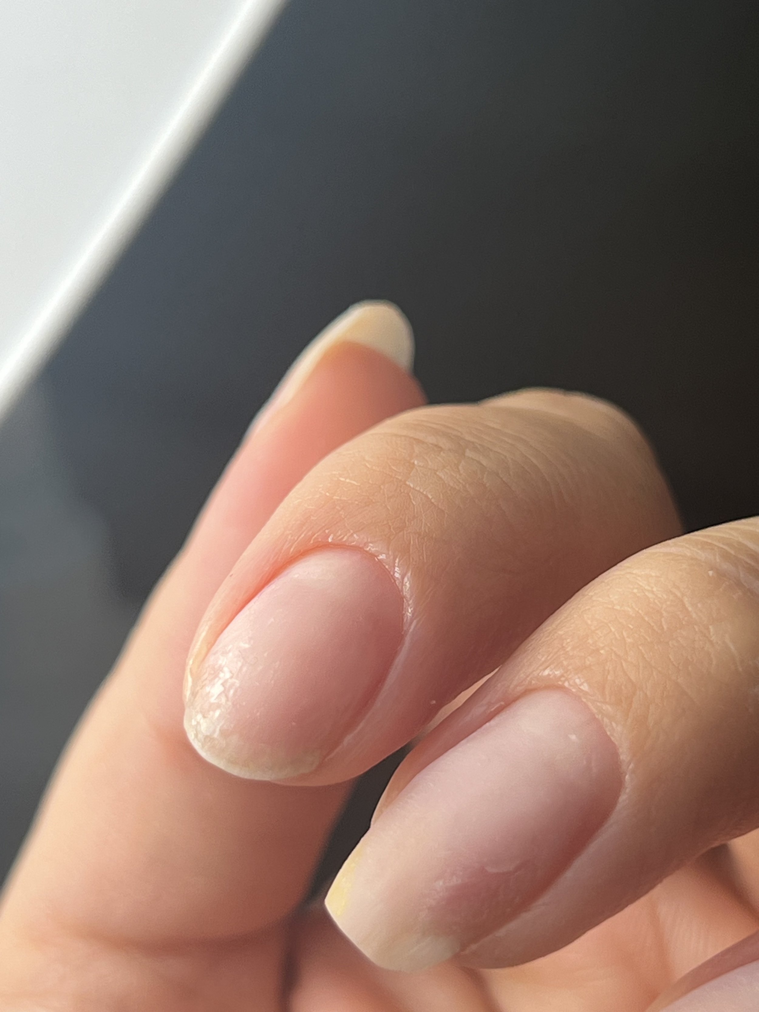 Close-up of a person's fingernails and fingers with natural skin tone, showing some dryness and minor peeling on the nail tips.