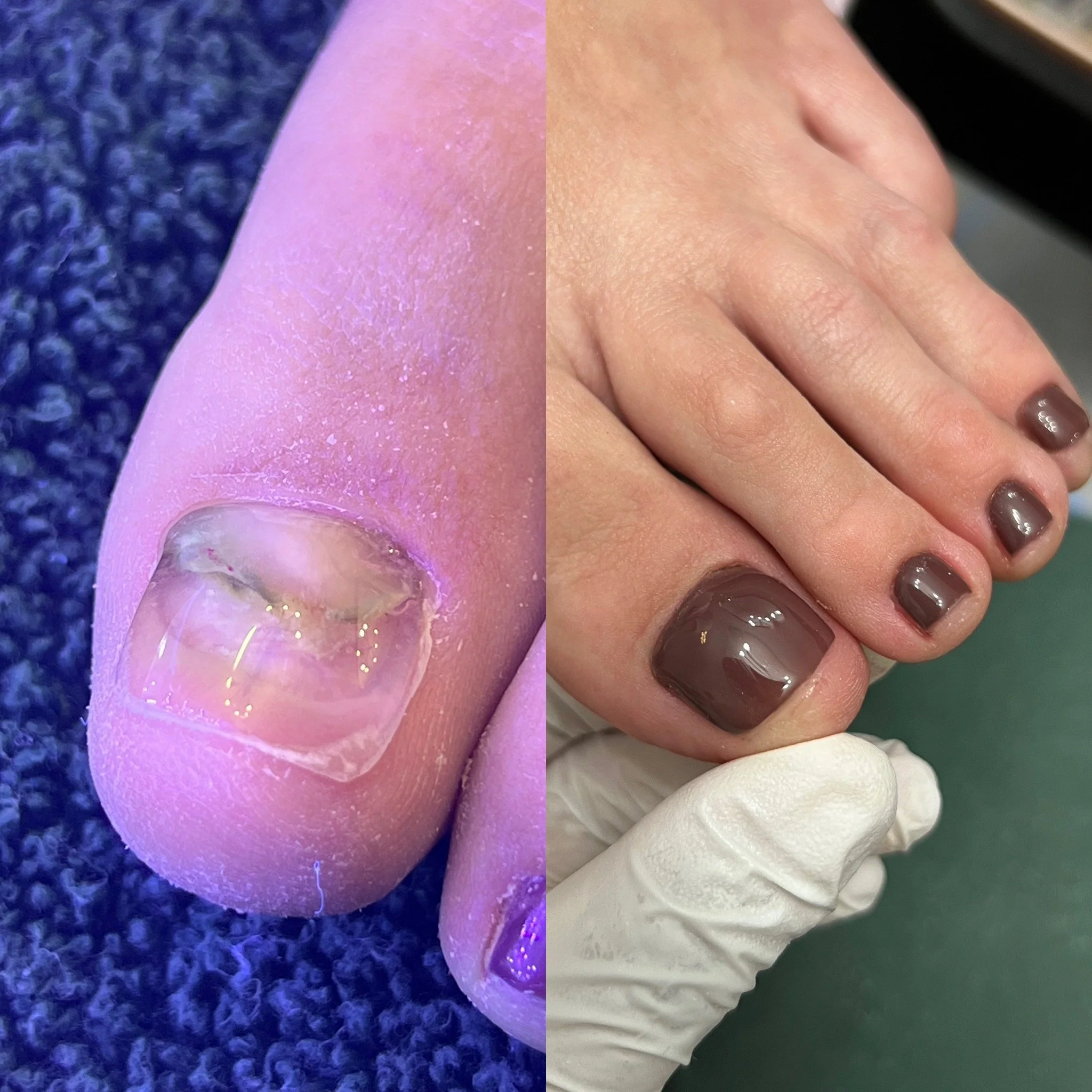 Toe nail reconstruction