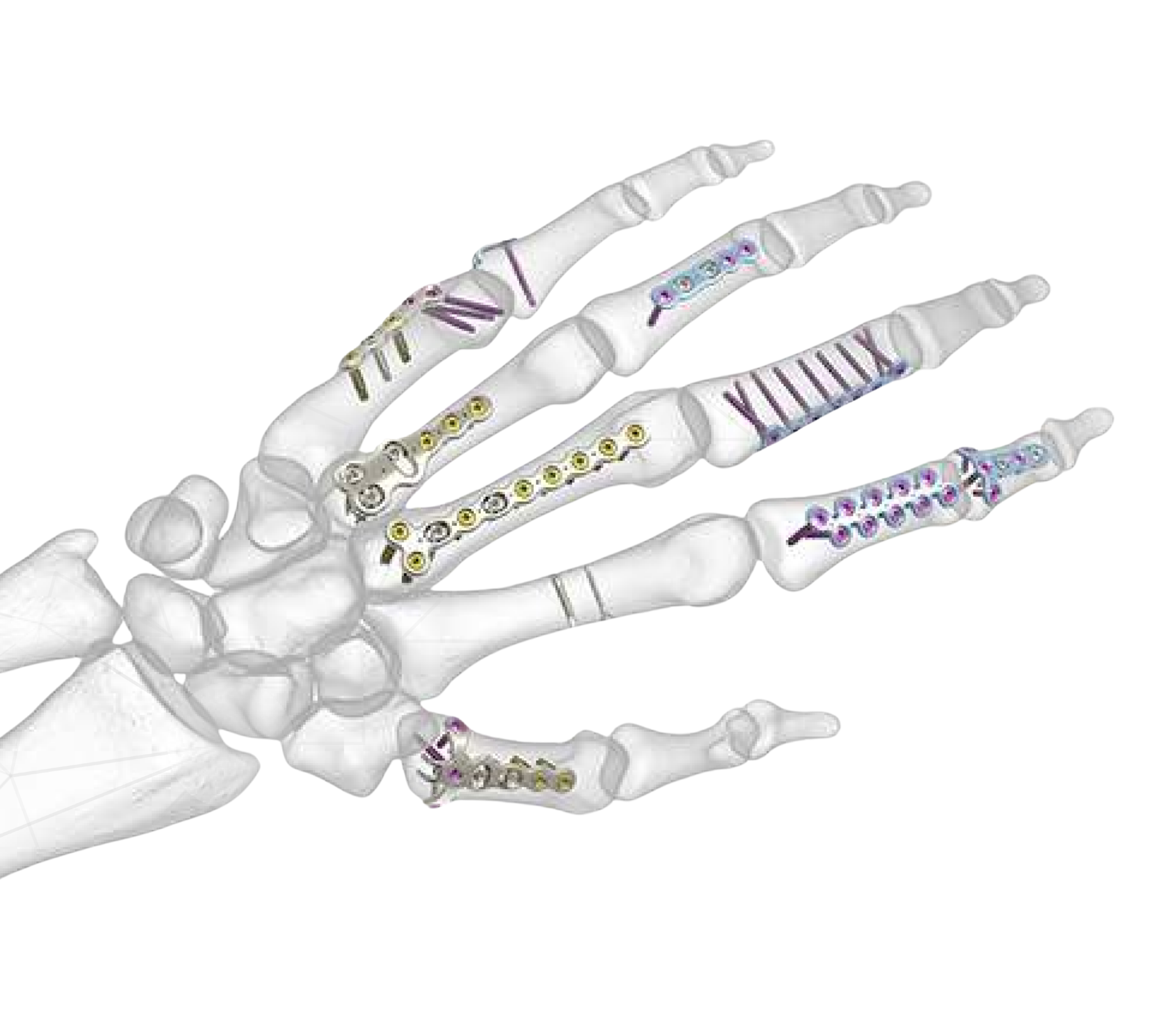 Sistema de Mini Fragmentos para Mano y Muñeca