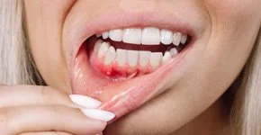 Pessoa mostrando a língua com ferida ou sangramento.