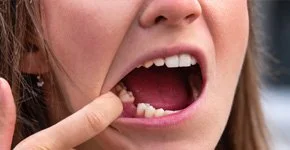 Pessoa com a boca aberta, apontando para um dente em uma de suas mãos.