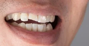 Mordida facial mostrando dentes e boca parcialmente abertas