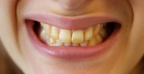 Sorriso de uma pessoa com dentes amarelos e tortos.