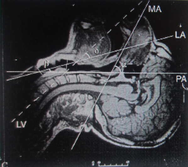 MRI scan of a human brain showing labeled regions including the ma, la, pa, lv, pet, and ca.