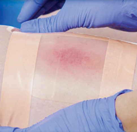 Close-up of a medical procedure showing a person's skin with redness and irritation, being handled by gloved hands.