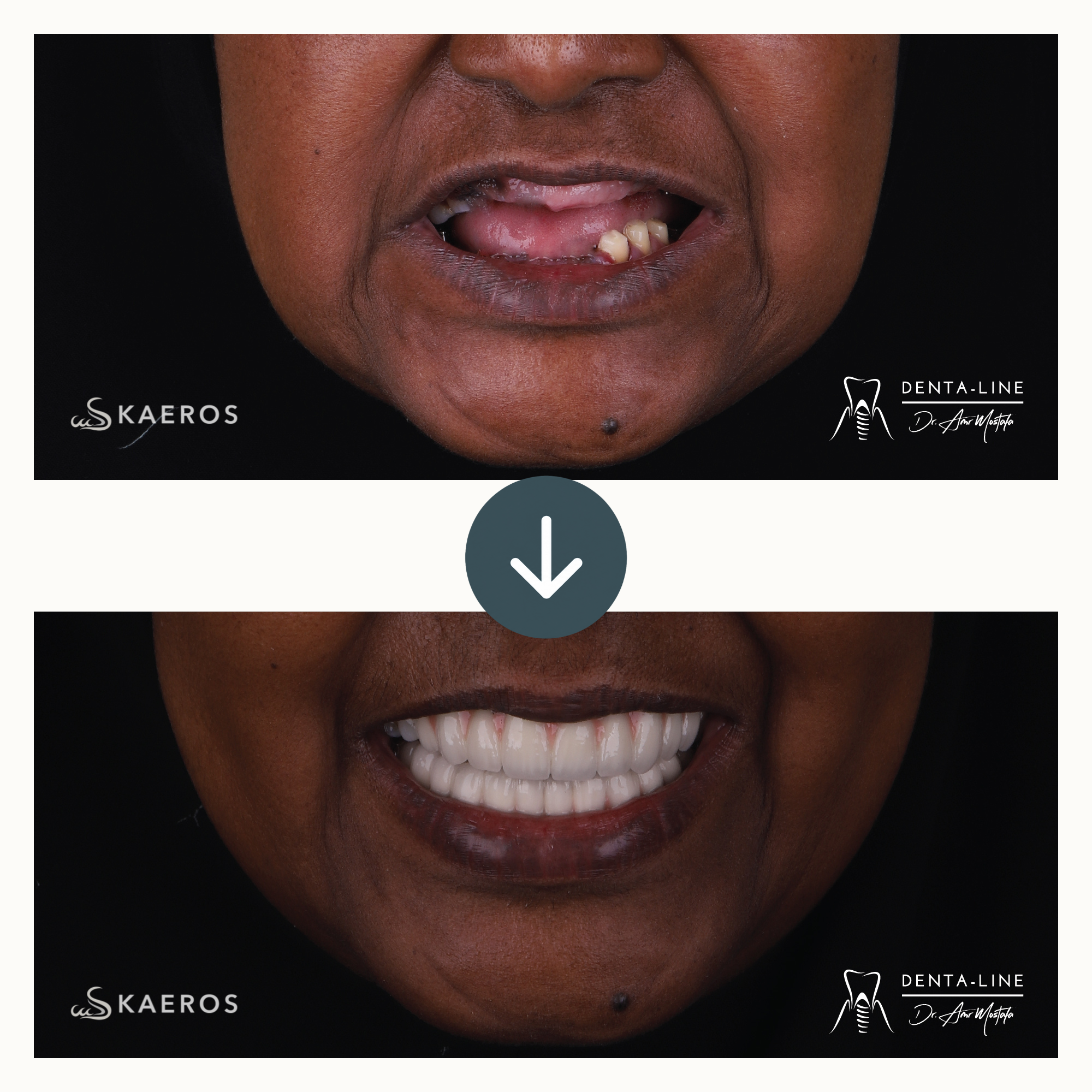 Dental Implants (4).png