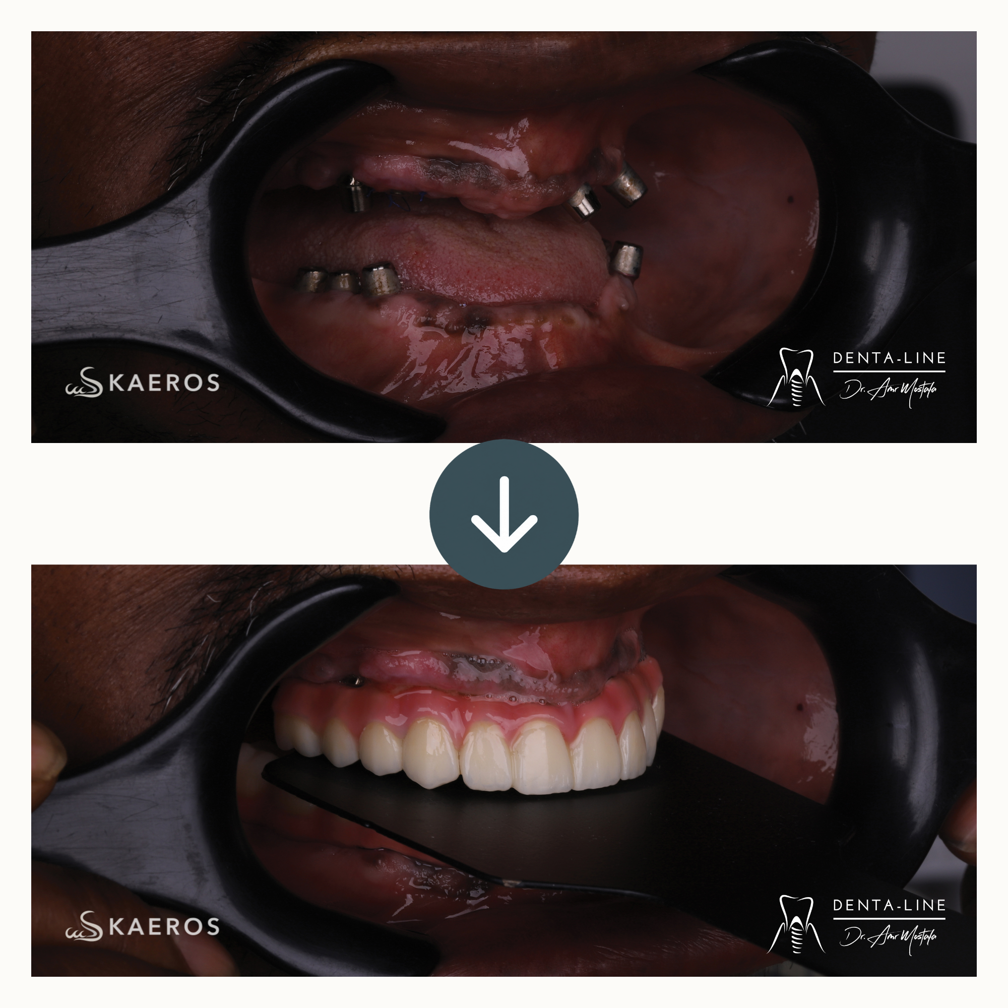 Dental Implants (7).png