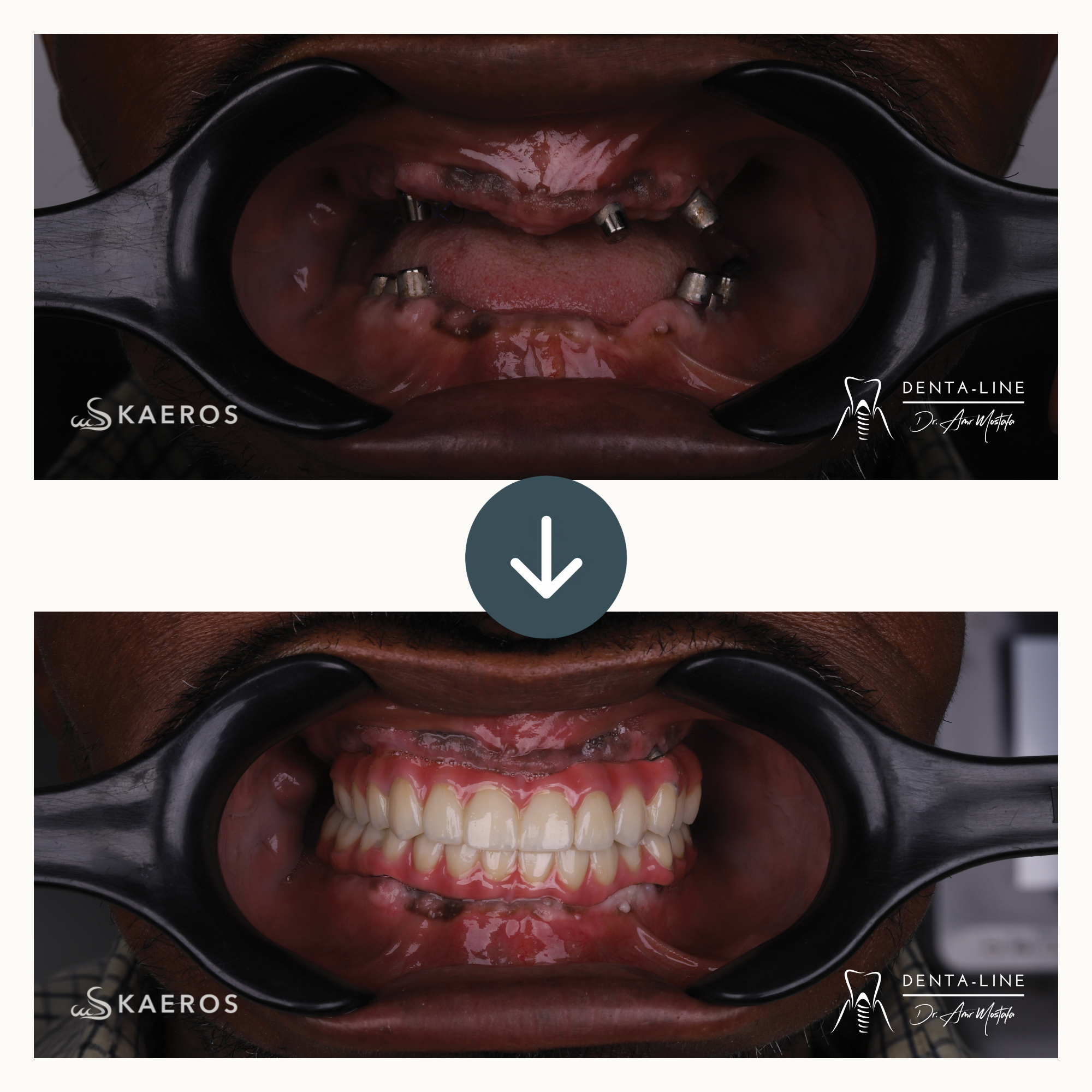 Dental Implants (6).png