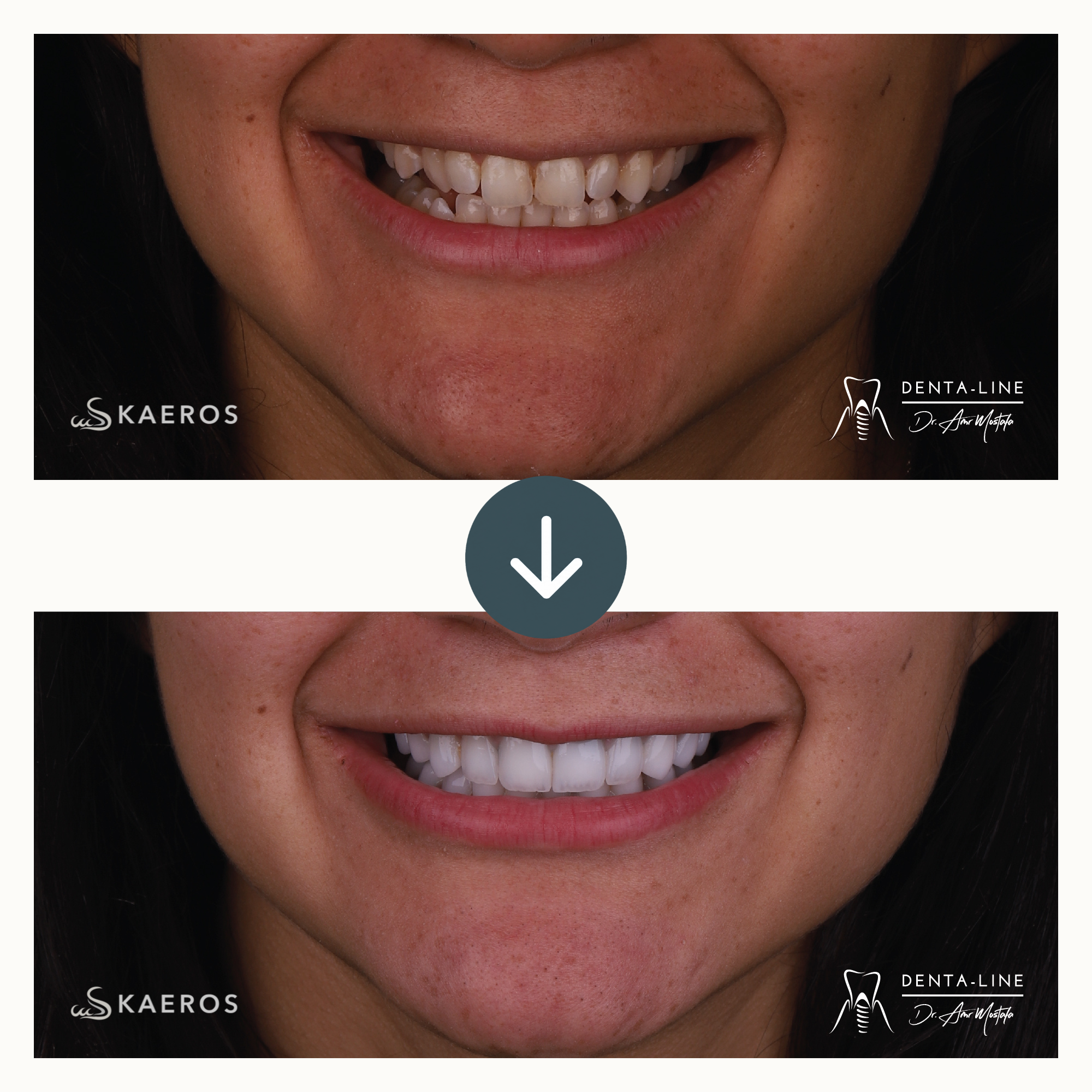 Veneers (23).png