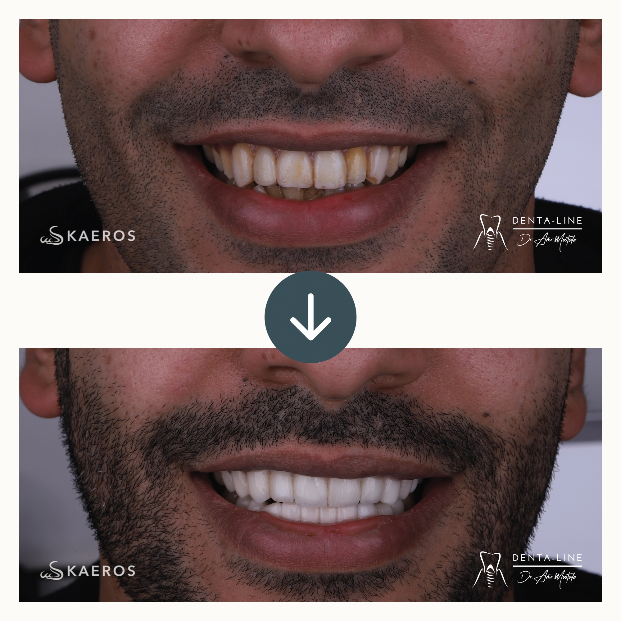 Veneers (14).png