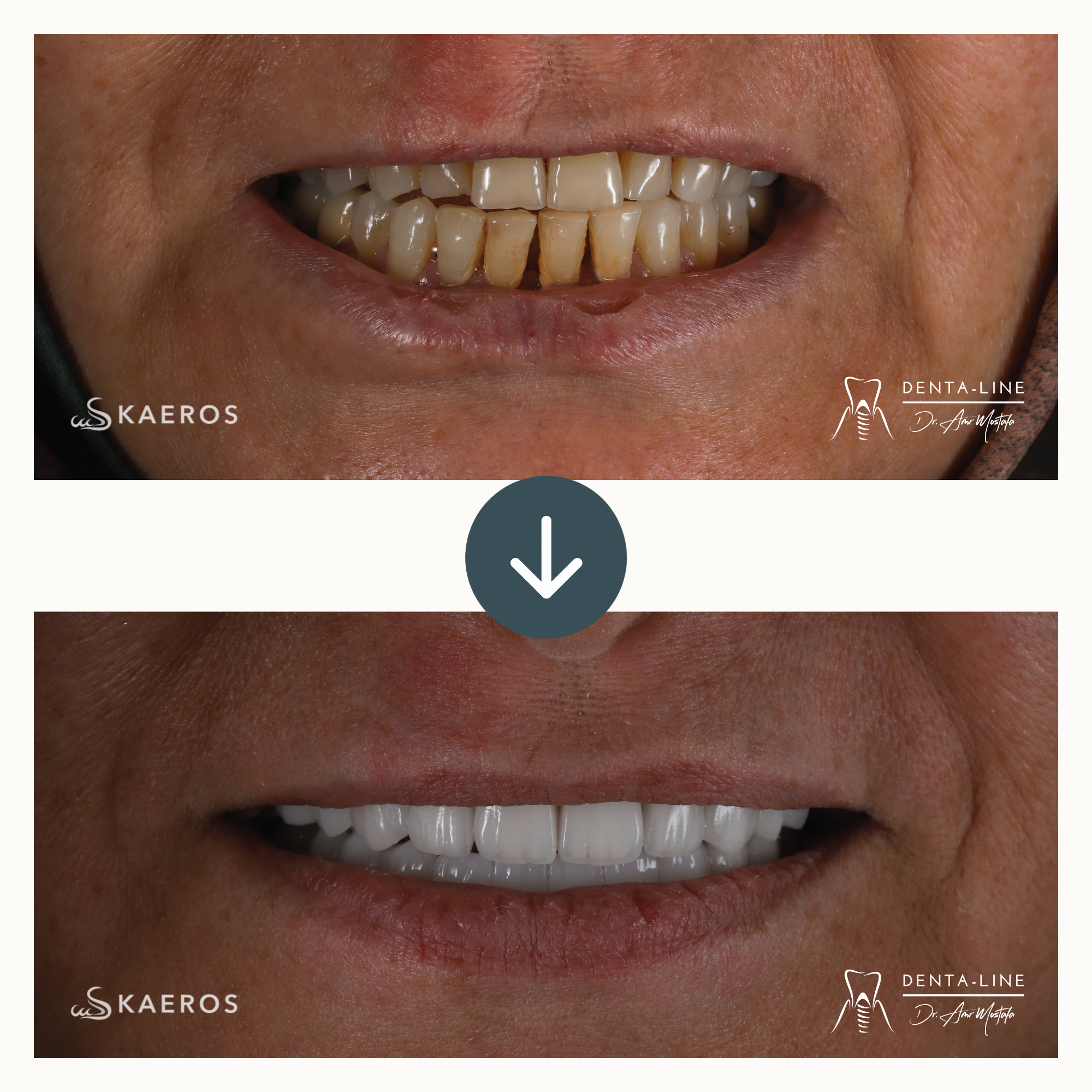 Veneers (29).png