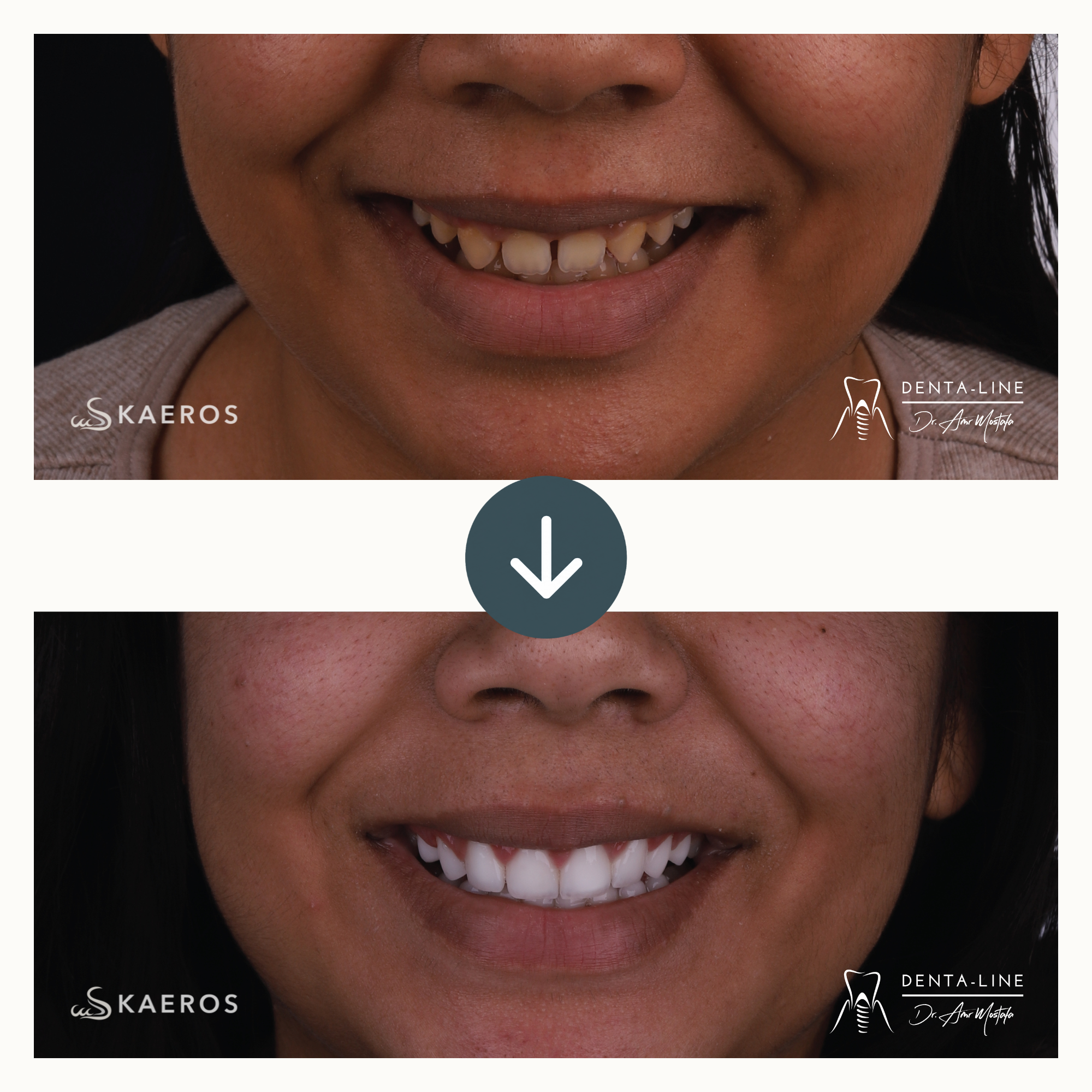 Veneers (7).png
