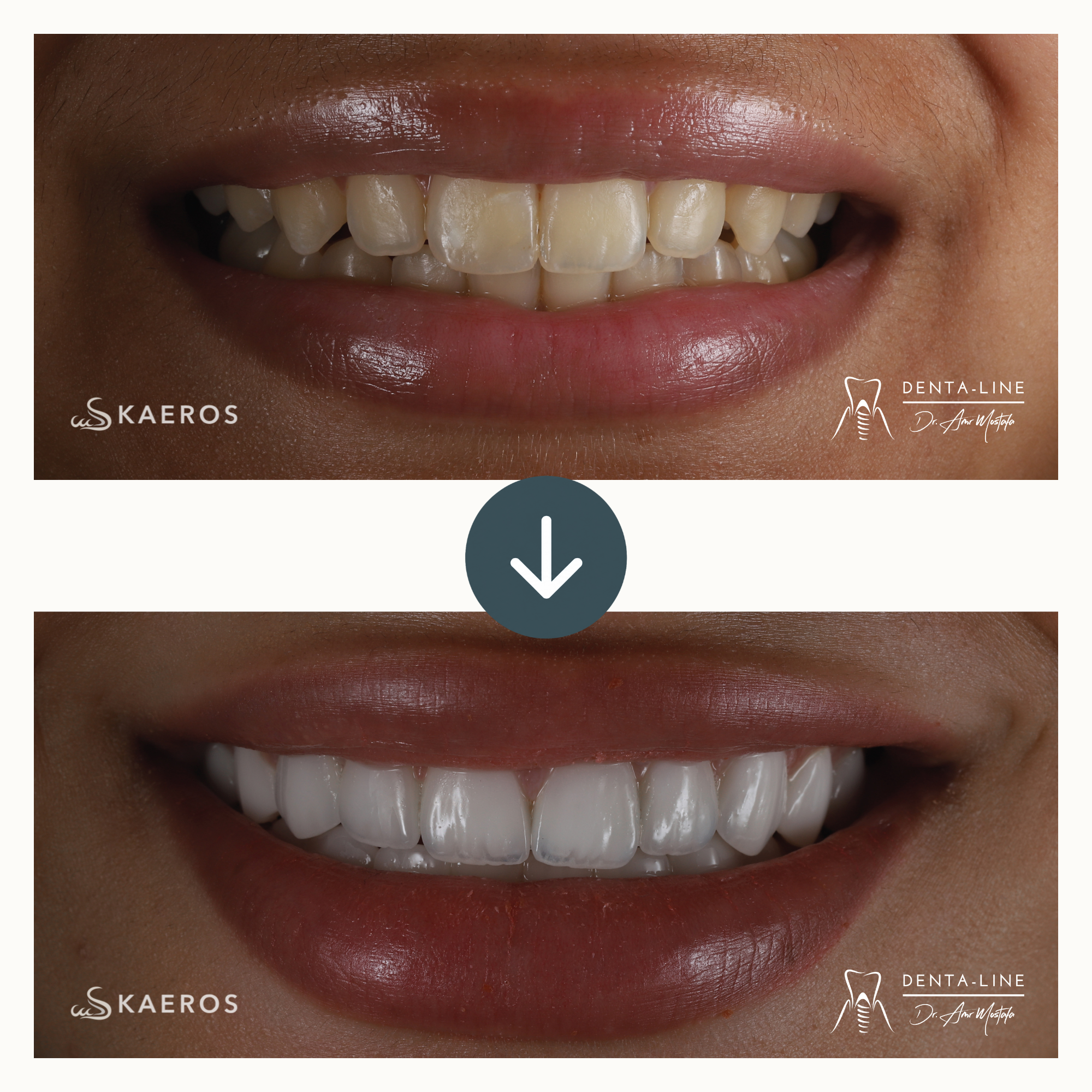 Veneers (24).png