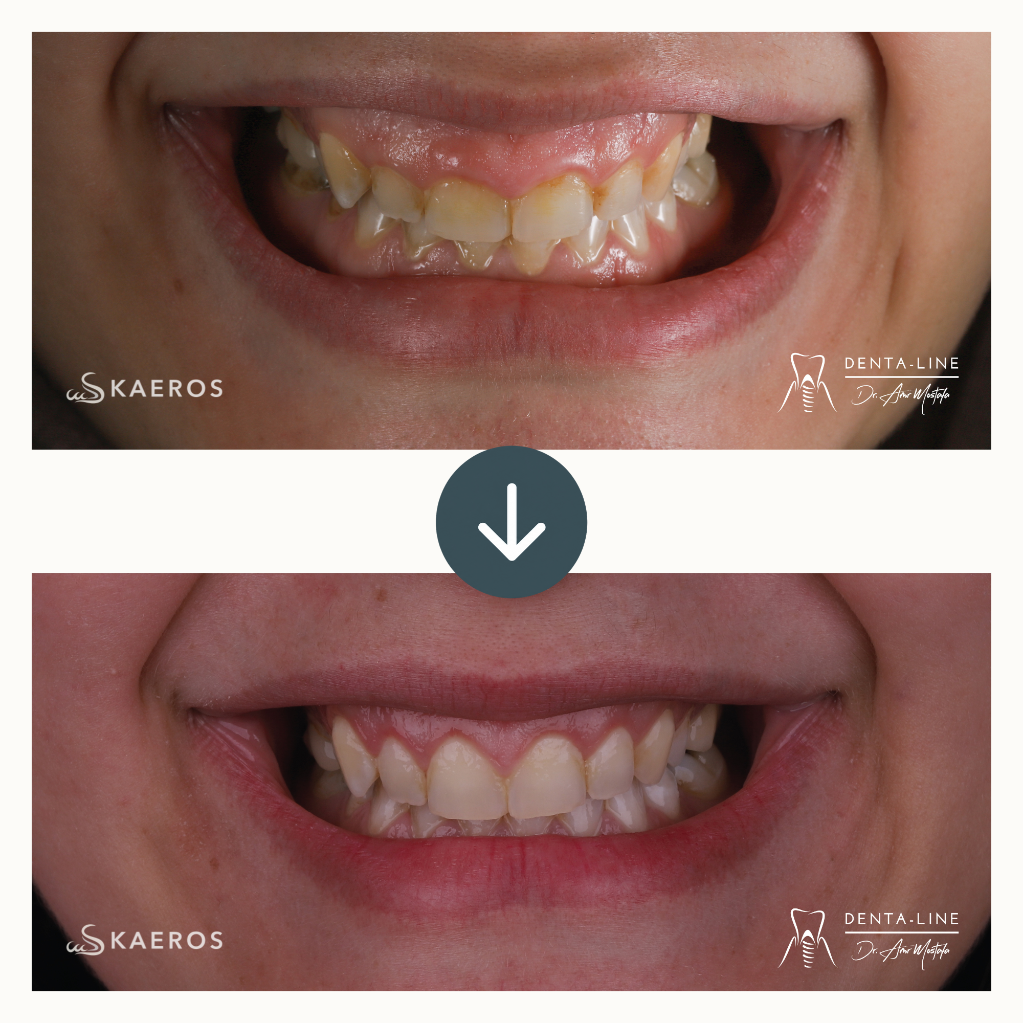 Gum Treatment 2.png
