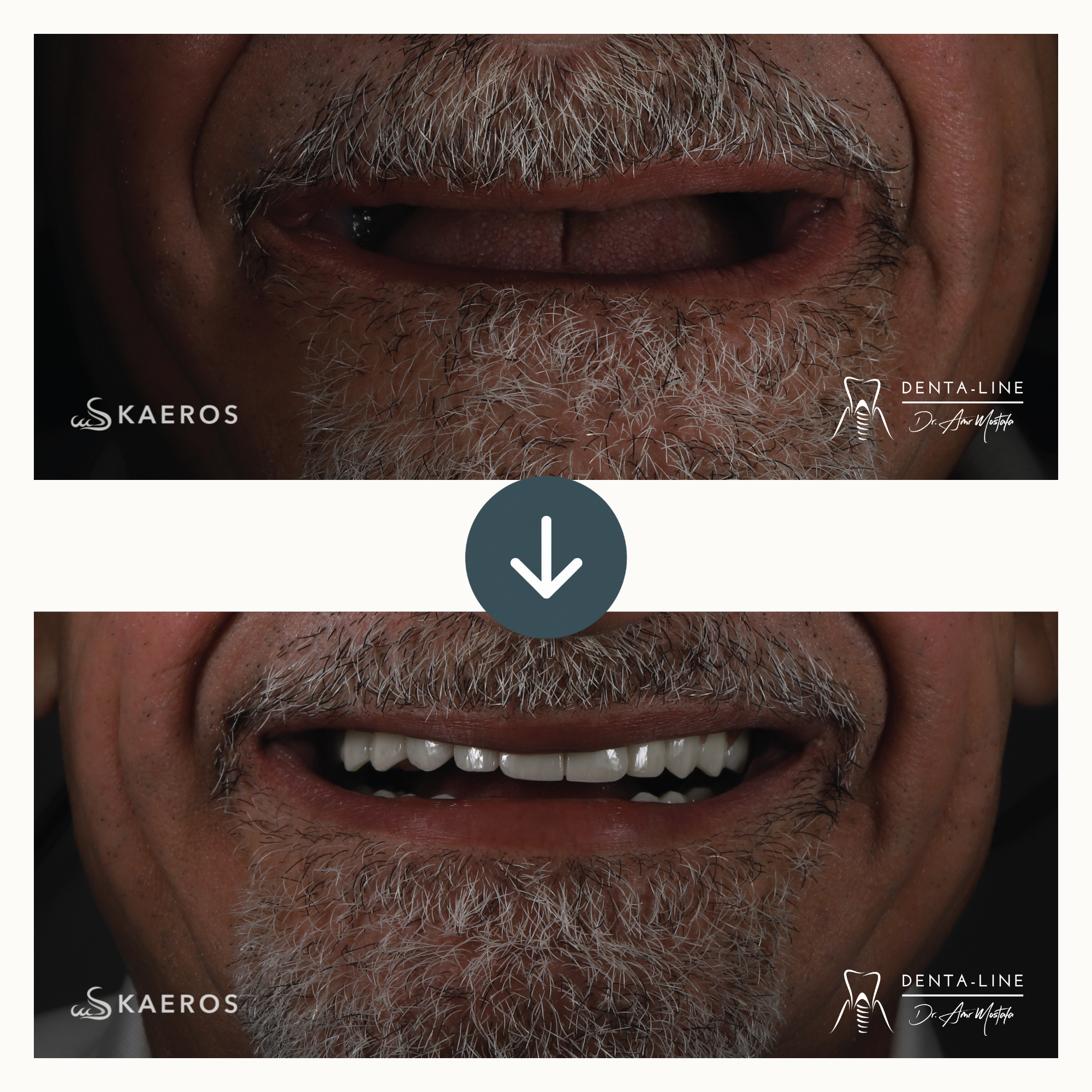 Dental Implants (1).png