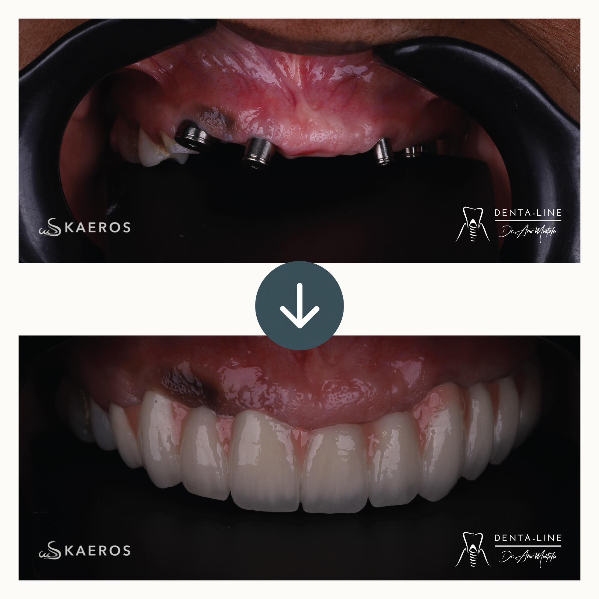 Dental Implants.png