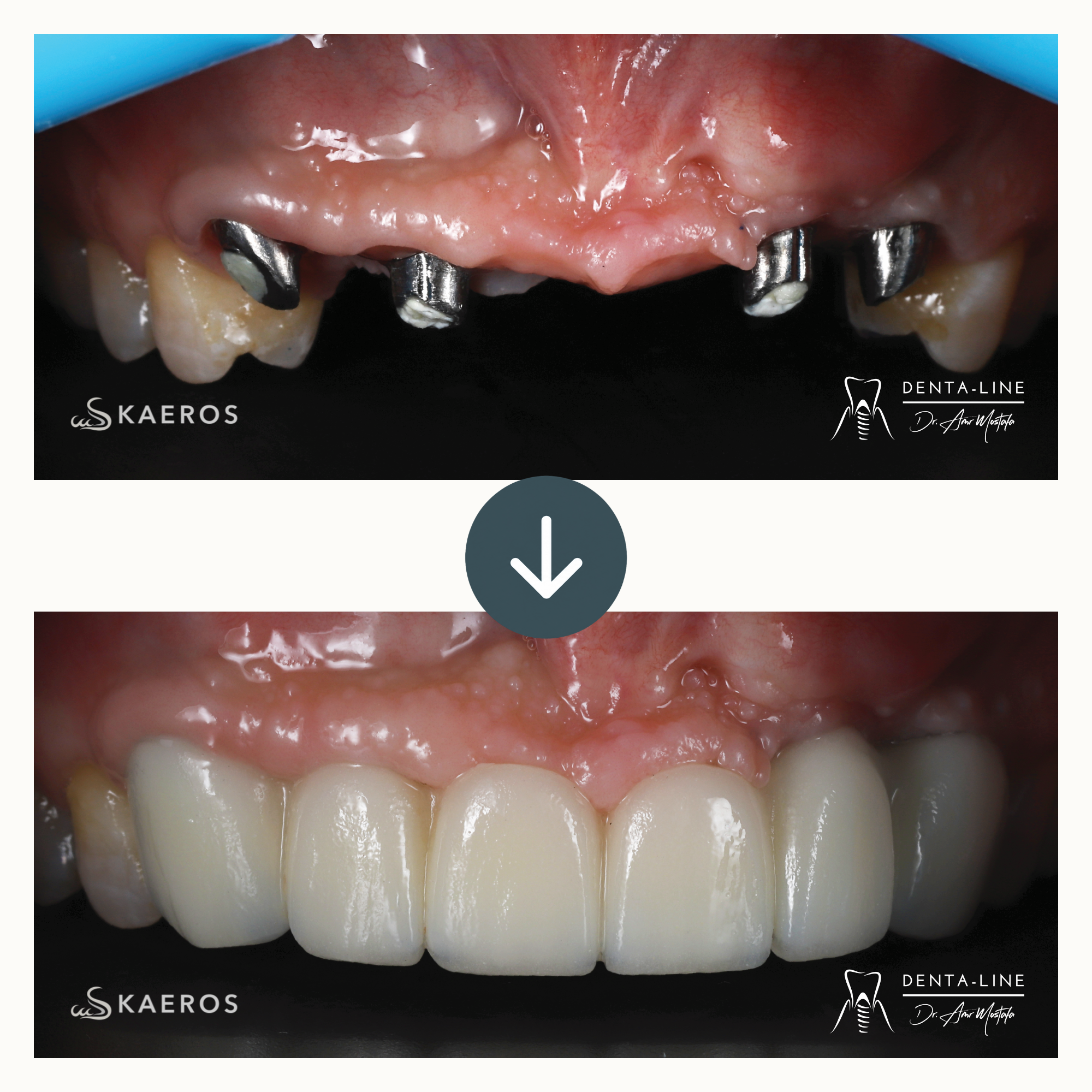 Dental Implants (8).png