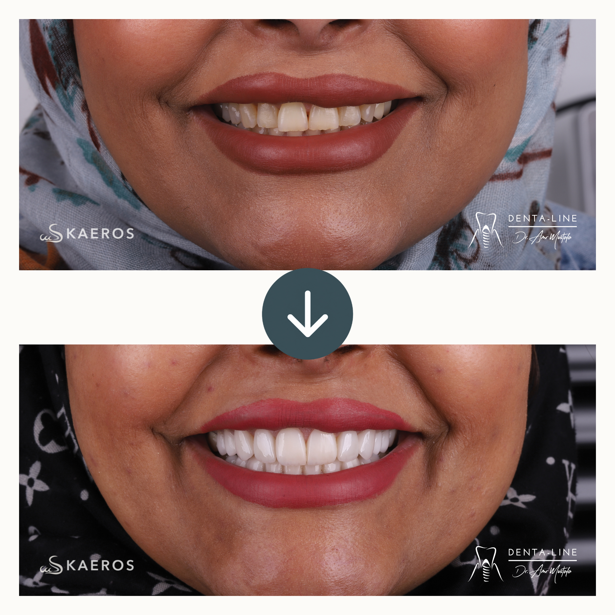 Veneers (5).png