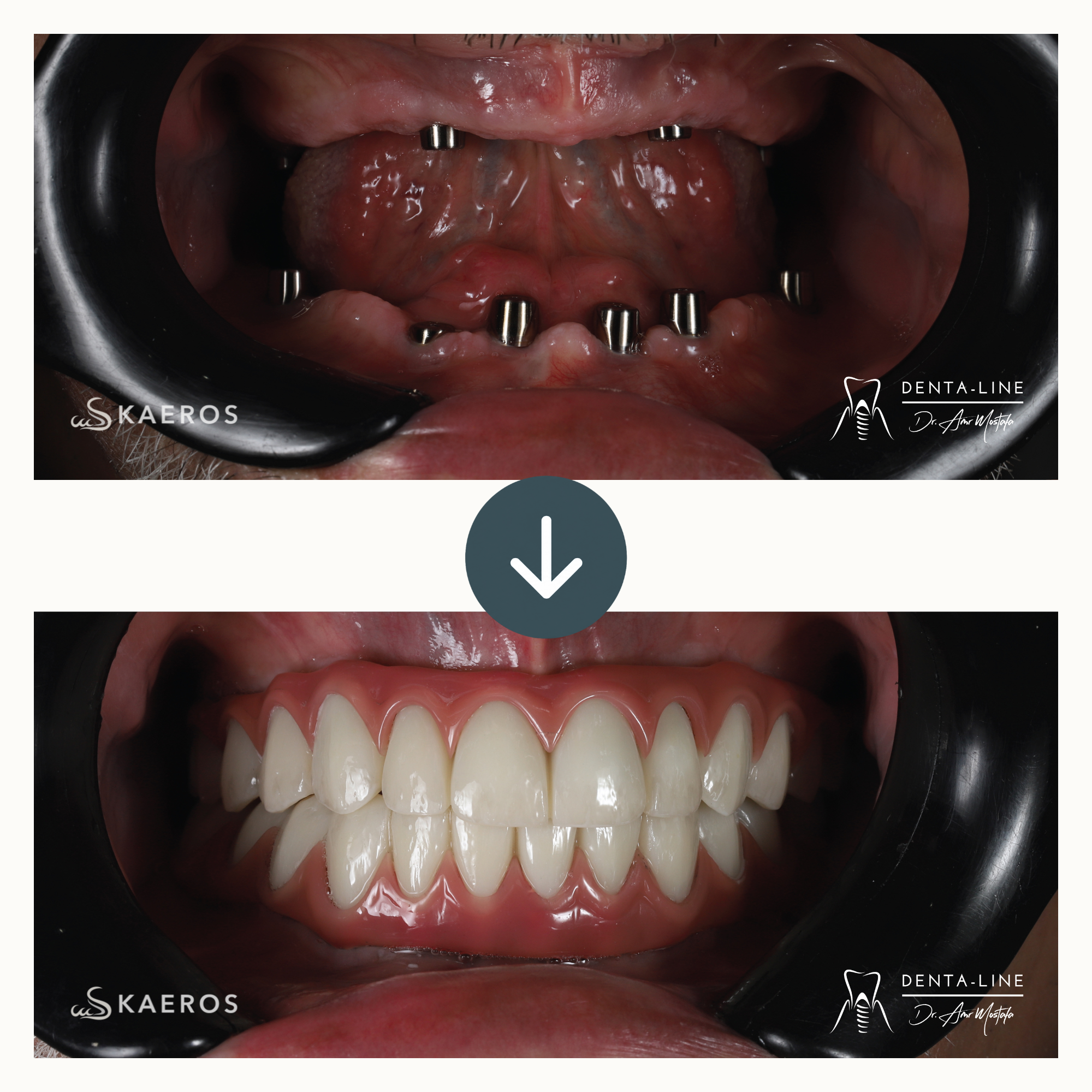 Dental Implants (3).png