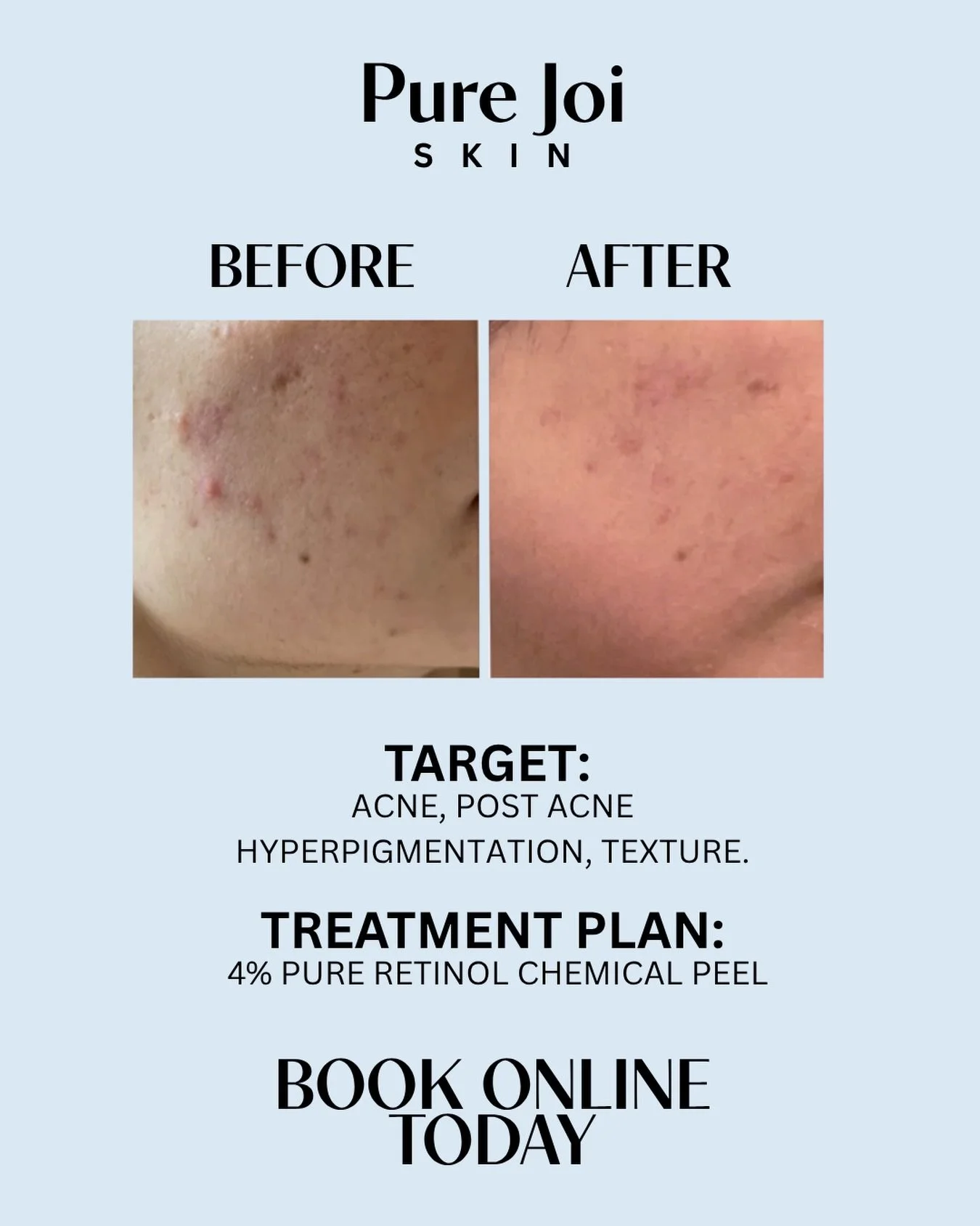 This transformation is all about consistency and intention. We targeted active acne, post-acne hyperpigmentation, and uneven texture using a customized approach: featuring a 4% pure retinol chemical peel.
At Pure Joi Skin, it&rsquo;s never just about