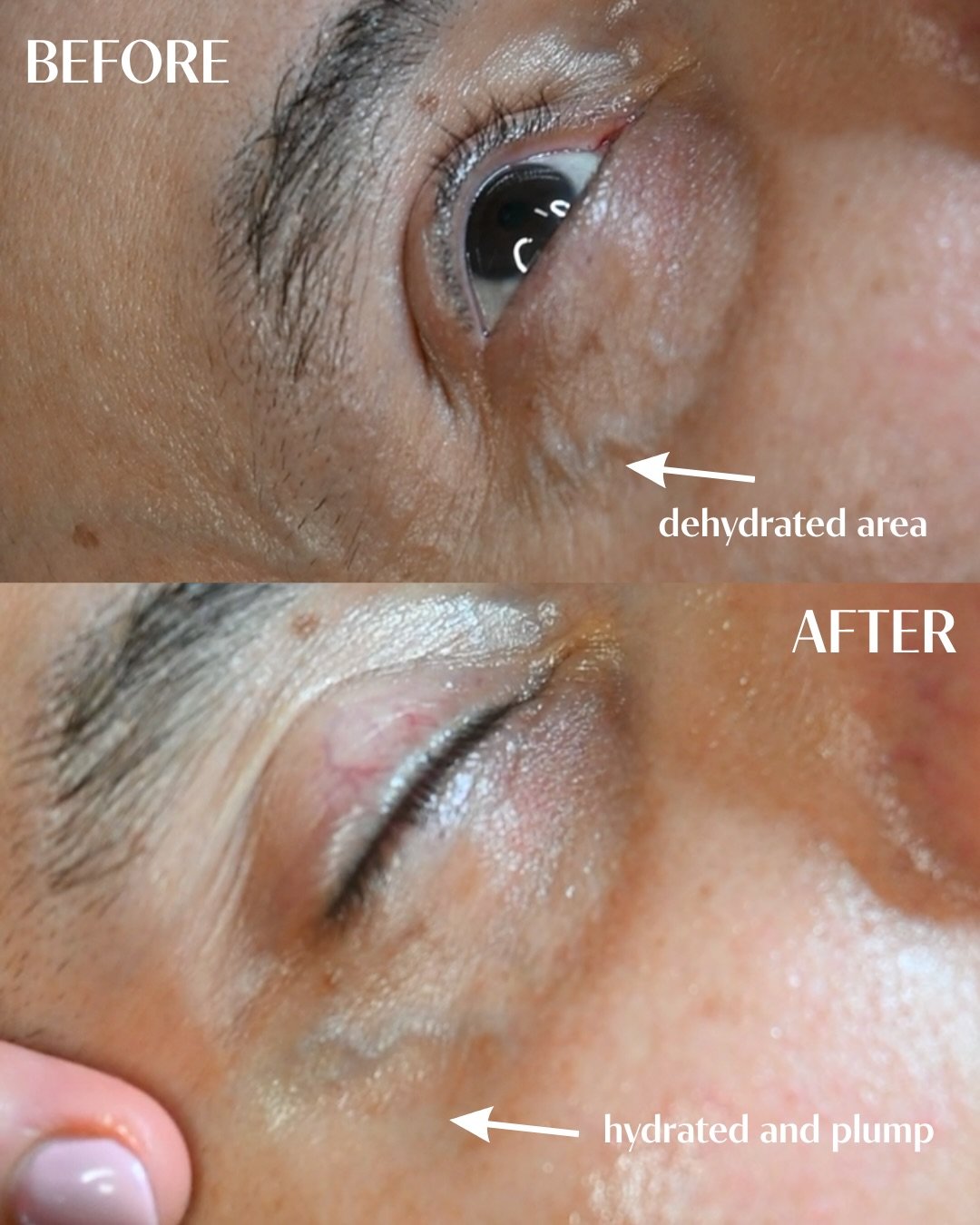 This client came in concerned about fine lines around the eye area.After the  skin consultation I realized that the skin around his eyes area was dehydrated and that was creating the impression of fine lines. 

By focusing on deep hydration and allow