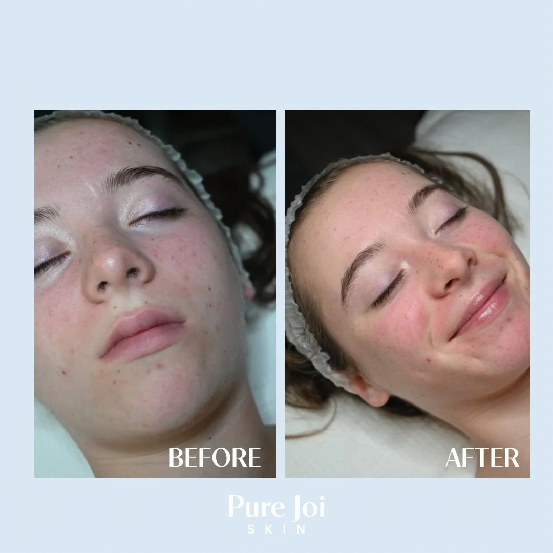 Teen skin doesn&rsquo;t need to be overcomplicated. 

One of the biggest misconceptions about teenage acne is that stronger products automatically mean better results. In reality, many teens are dealing with congestion, excess oil, inflammation, and 