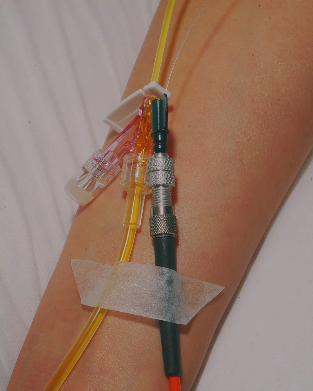 Close-up of a medical arm with a needle and tubing for intravenous therapy, secured with clear tape.