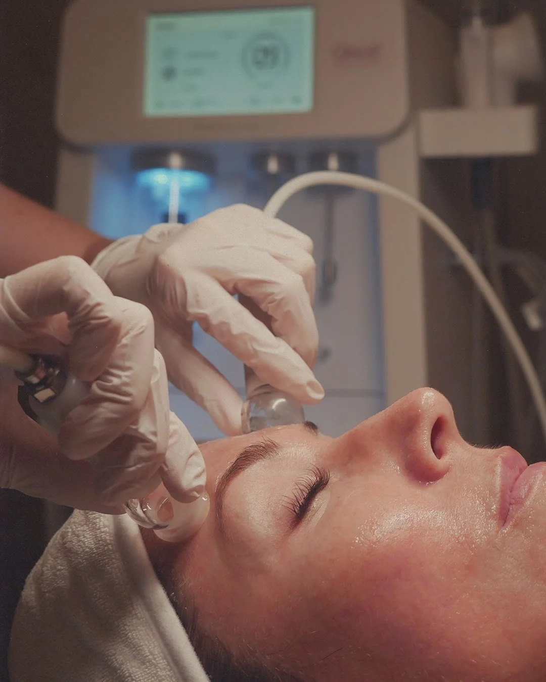 A woman receiving a facial treatment with a small glass vacuum pump on her face in a spa or clinic setting, with a machine in the background.