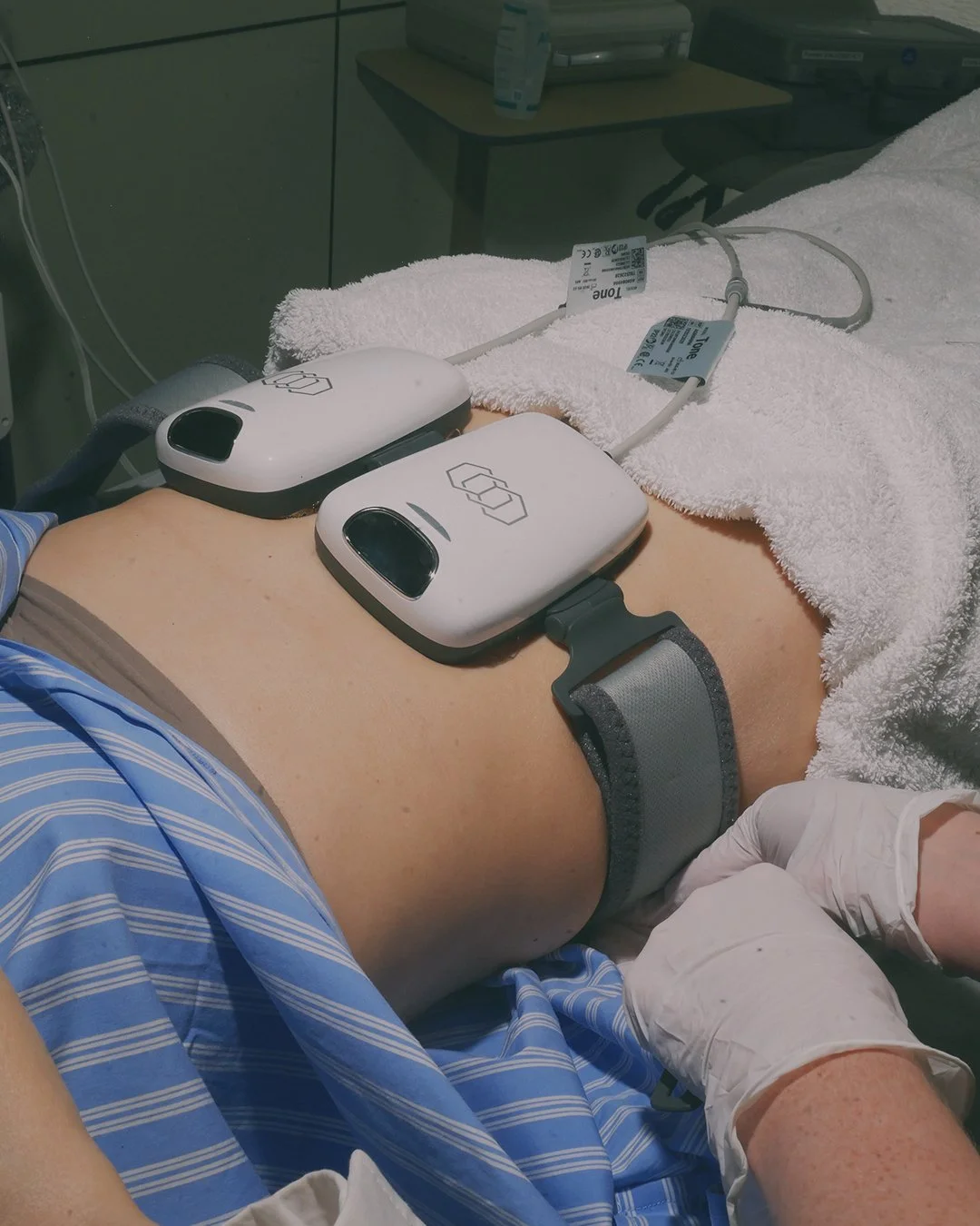 Patient lying in hospital bed with two transcutaneous nerve stimulation (TENS) units attached to their abdomen, wearing a hospital gown and latex gloves, with medical supplies in the background.