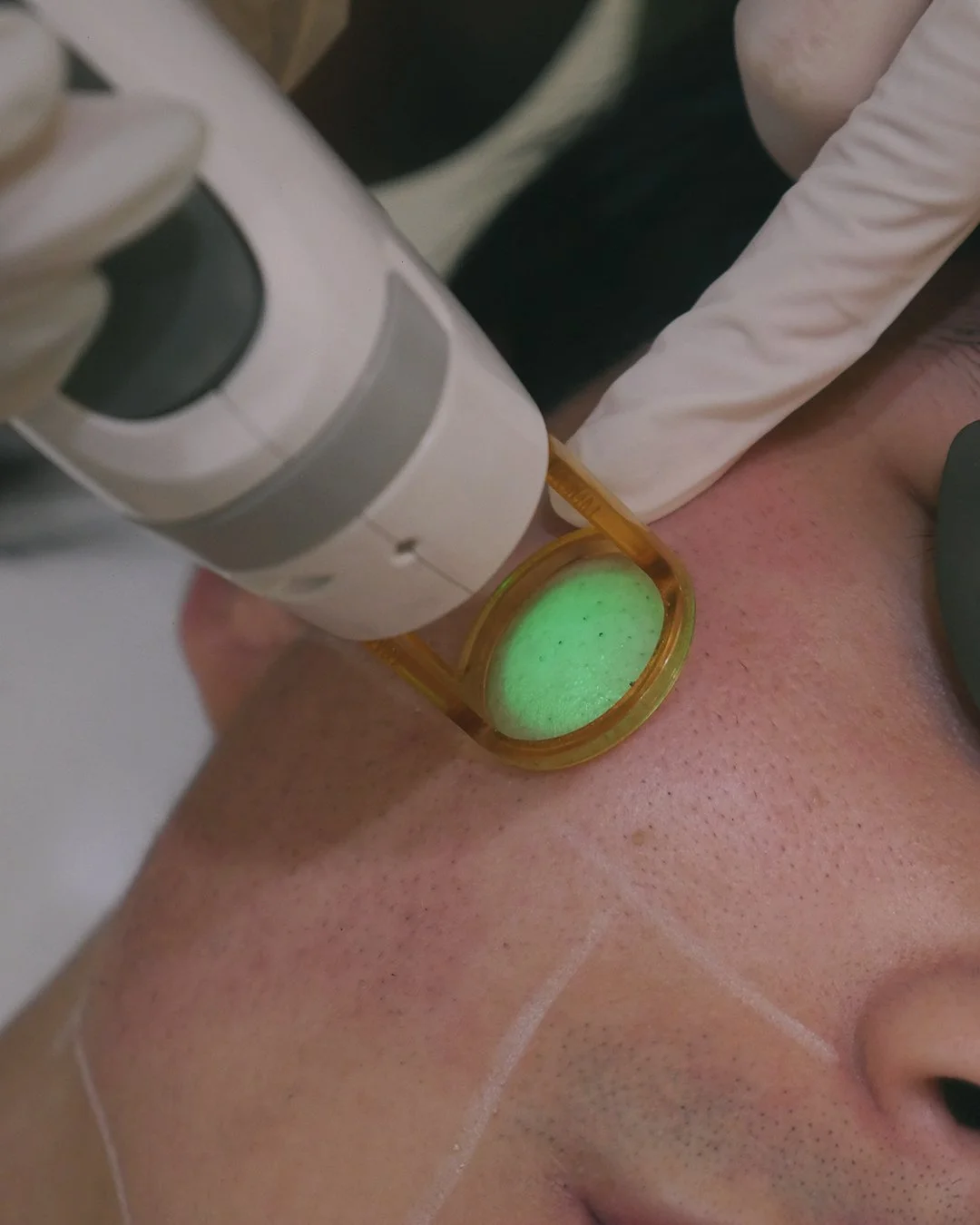 Person receiving a laser or ultrasound treatment on their neck or face, with a medical device emitting green light, overseen by a healthcare professional wearing gloves.