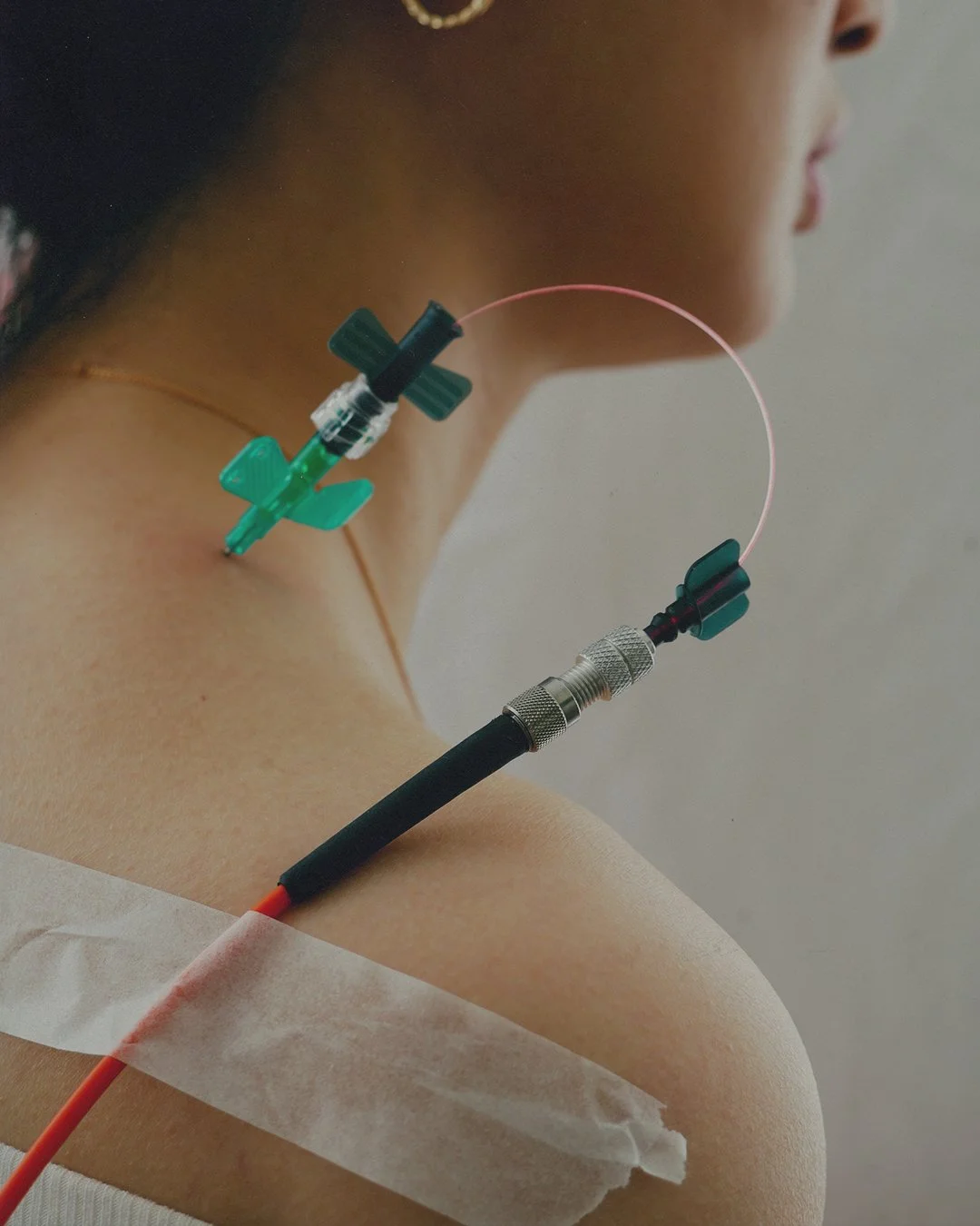Close-up of a person's shoulder with medical IV inserted, connected to a tube with a needle and adapter, and secured with tape.