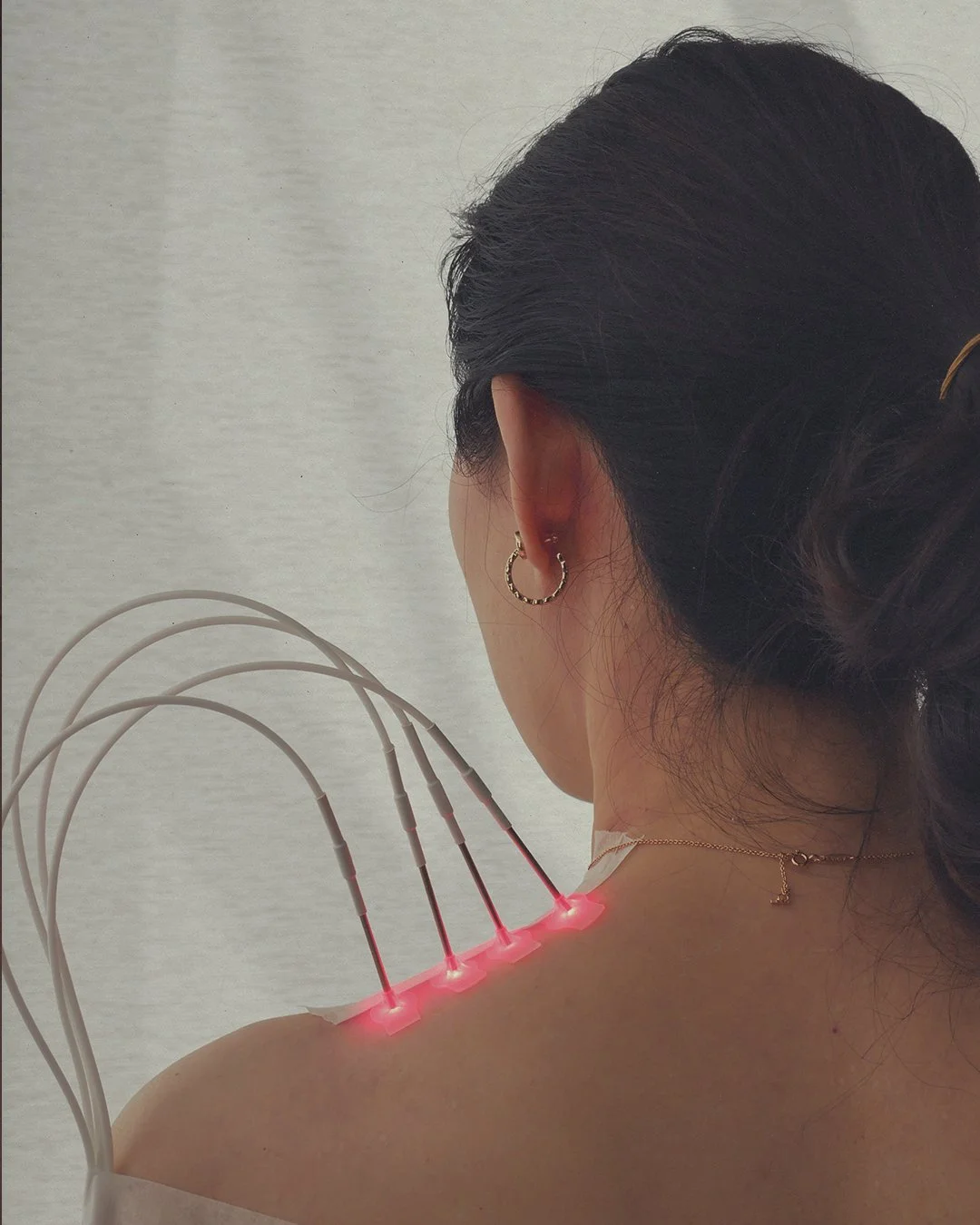 Woman receiving acupuncture treatment on her shoulder with multiple thin needles connected to a machine emitting red light.