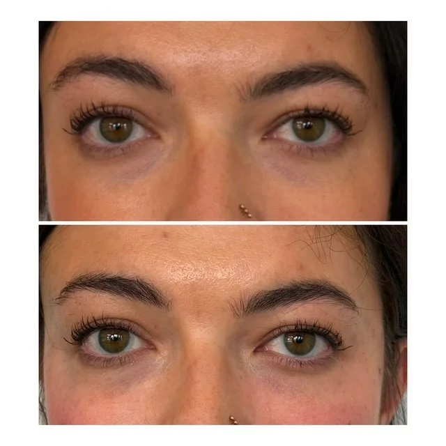 Before-and-after close-up photos showing changes in the appearance of fine lines and skin around the eyes.