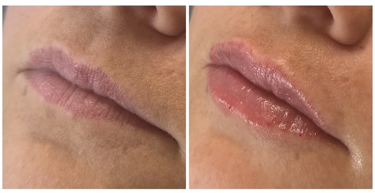 Side-by-side lip filler before-and-after photos showing increased lip volume and improved definition.